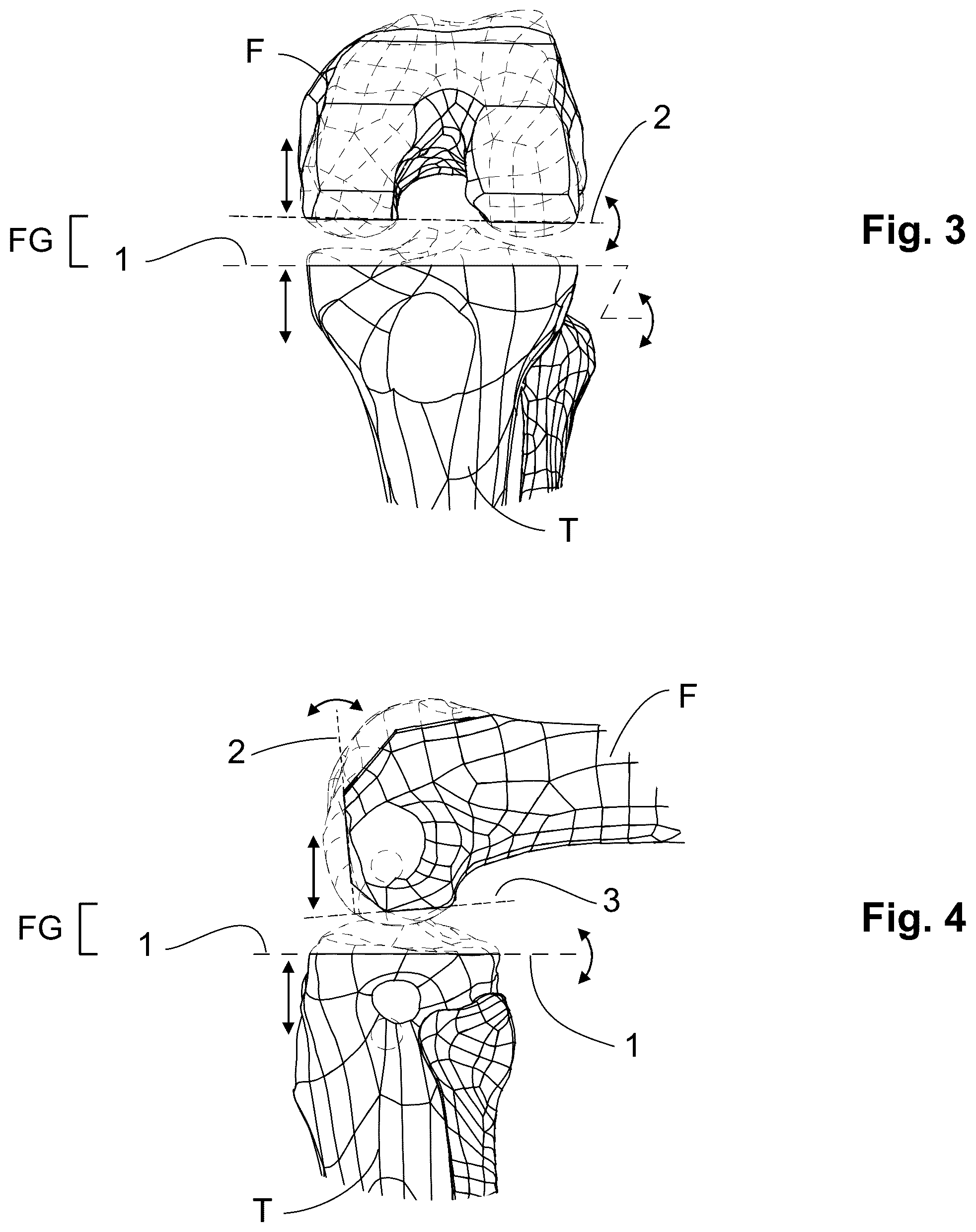 Patent US12303405 Figure 2 – Knee arthroplasty method