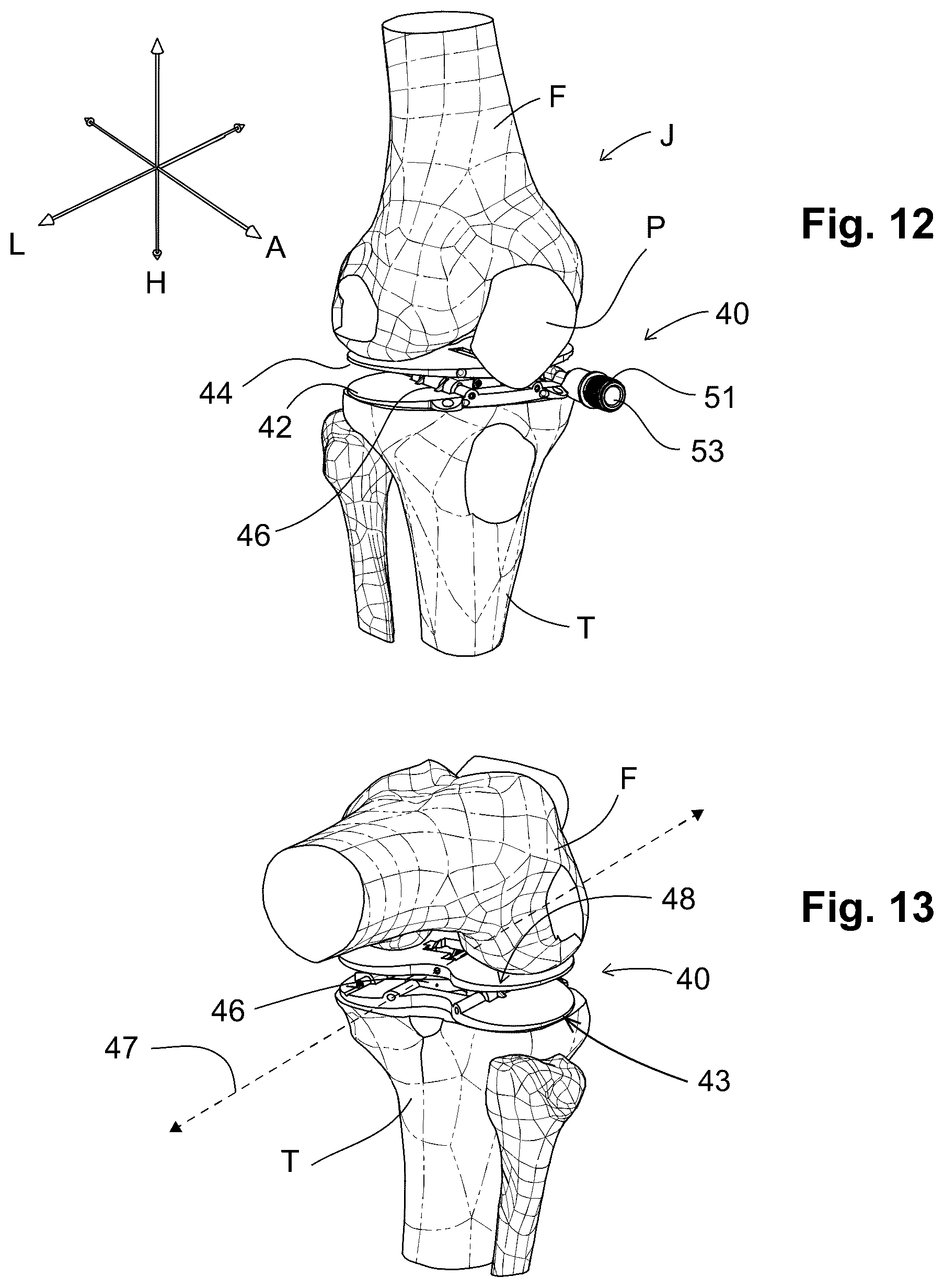 Patent US12303405 Figure 5 – Knee arthroplasty method