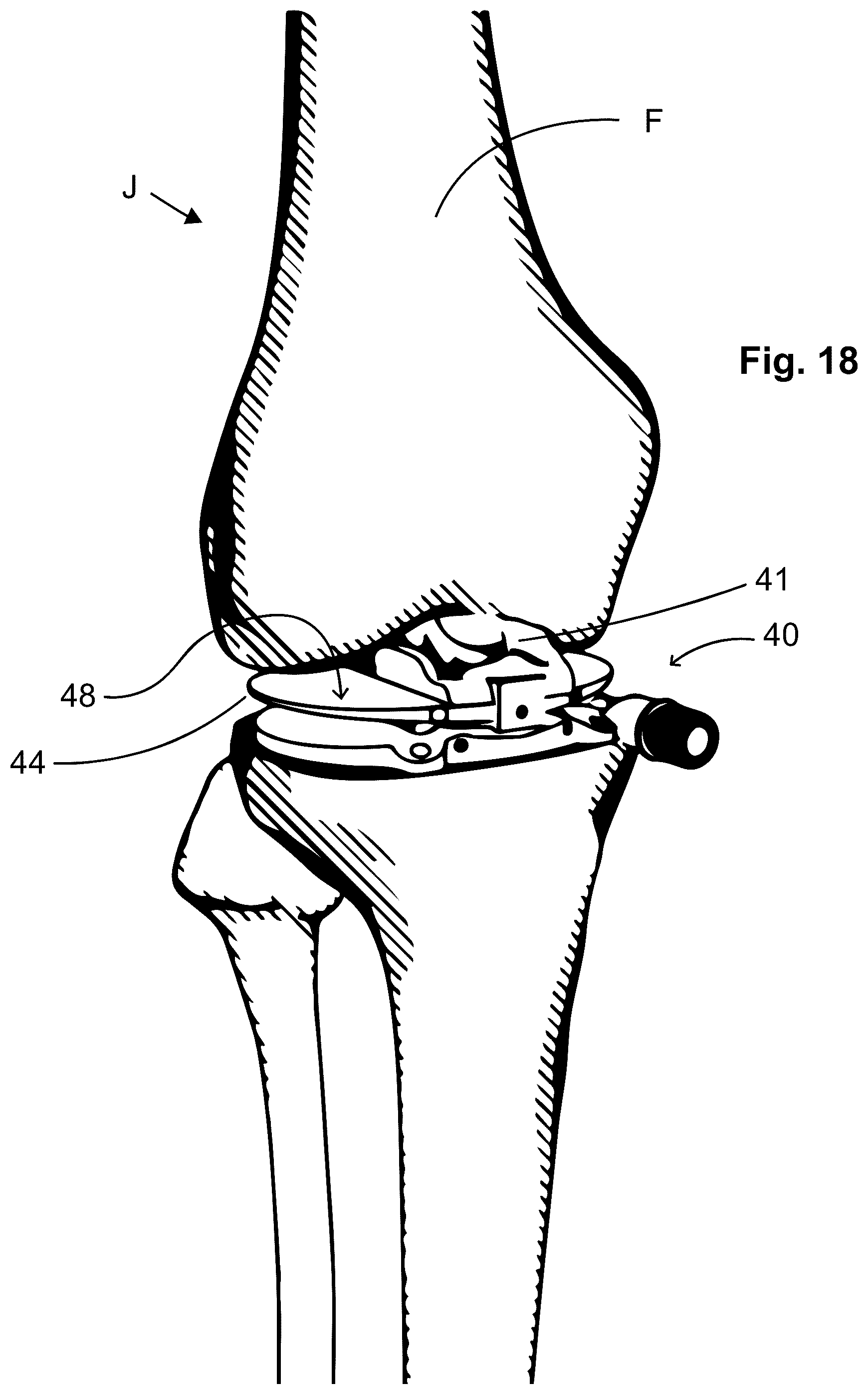 Patent US12303405 Figure 9 – Knee arthroplasty method