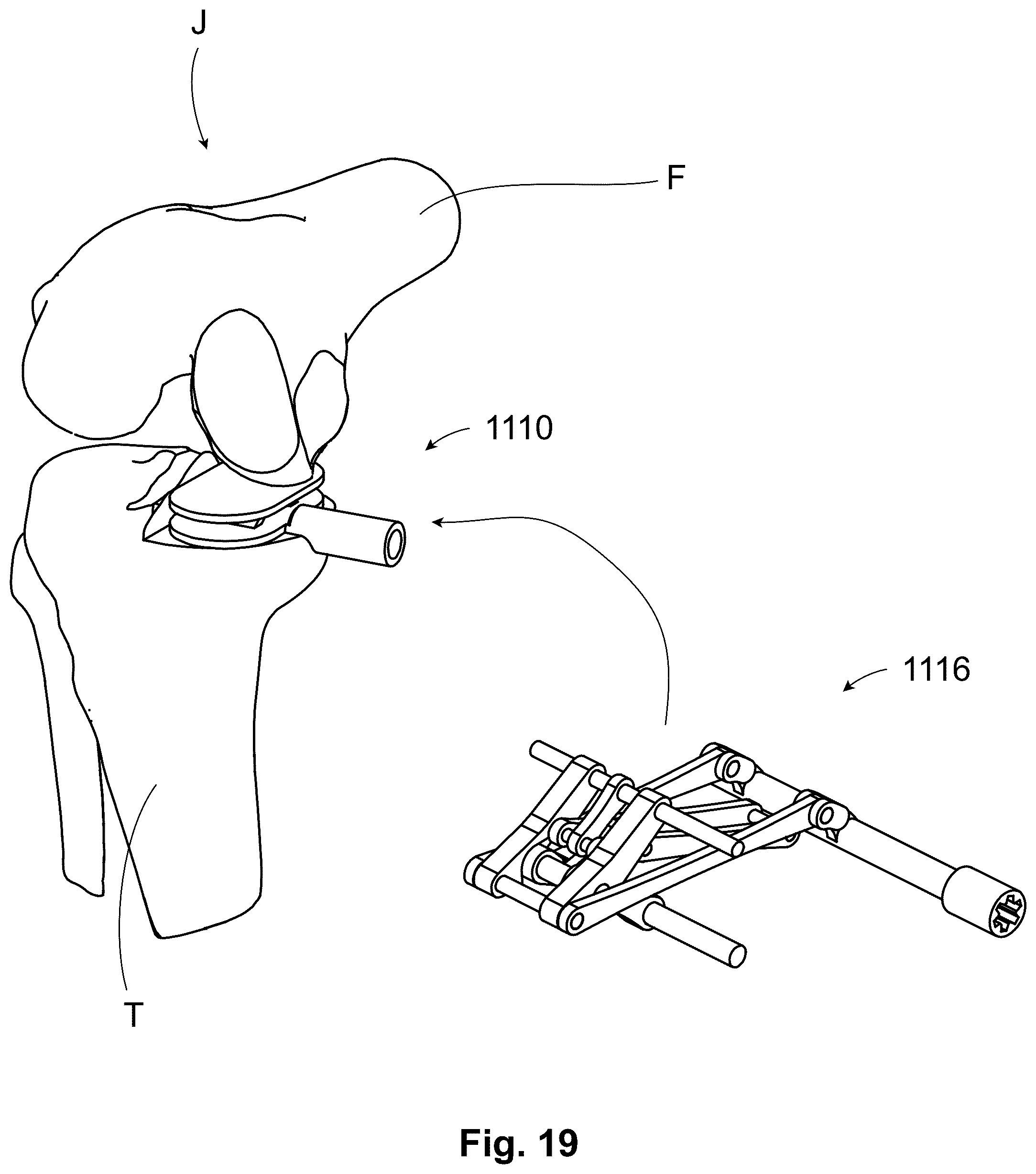 Patent US12303405 Figure 10 – Knee arthroplasty method