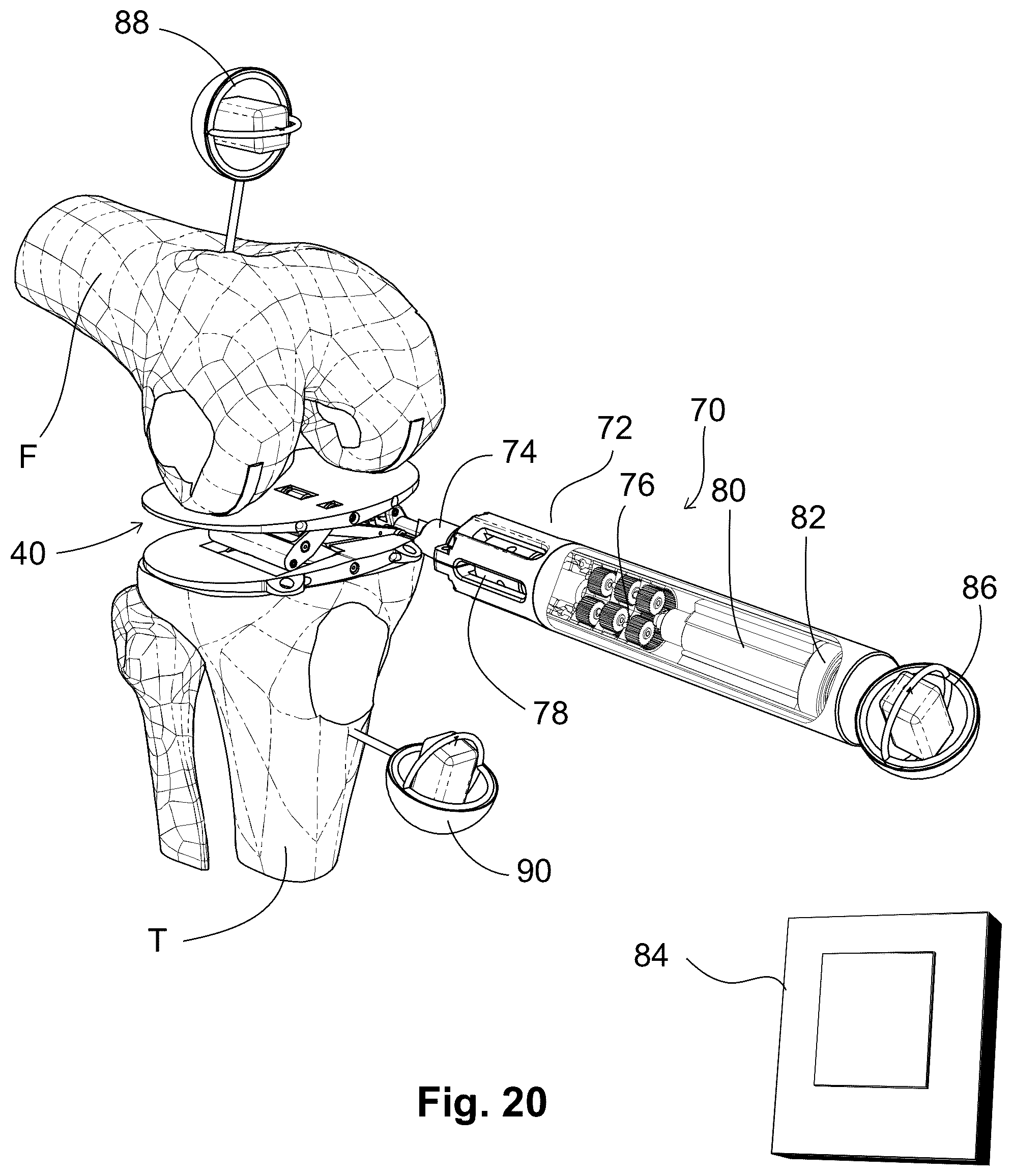 Patent US12303405 Figure 11 – Knee arthroplasty method