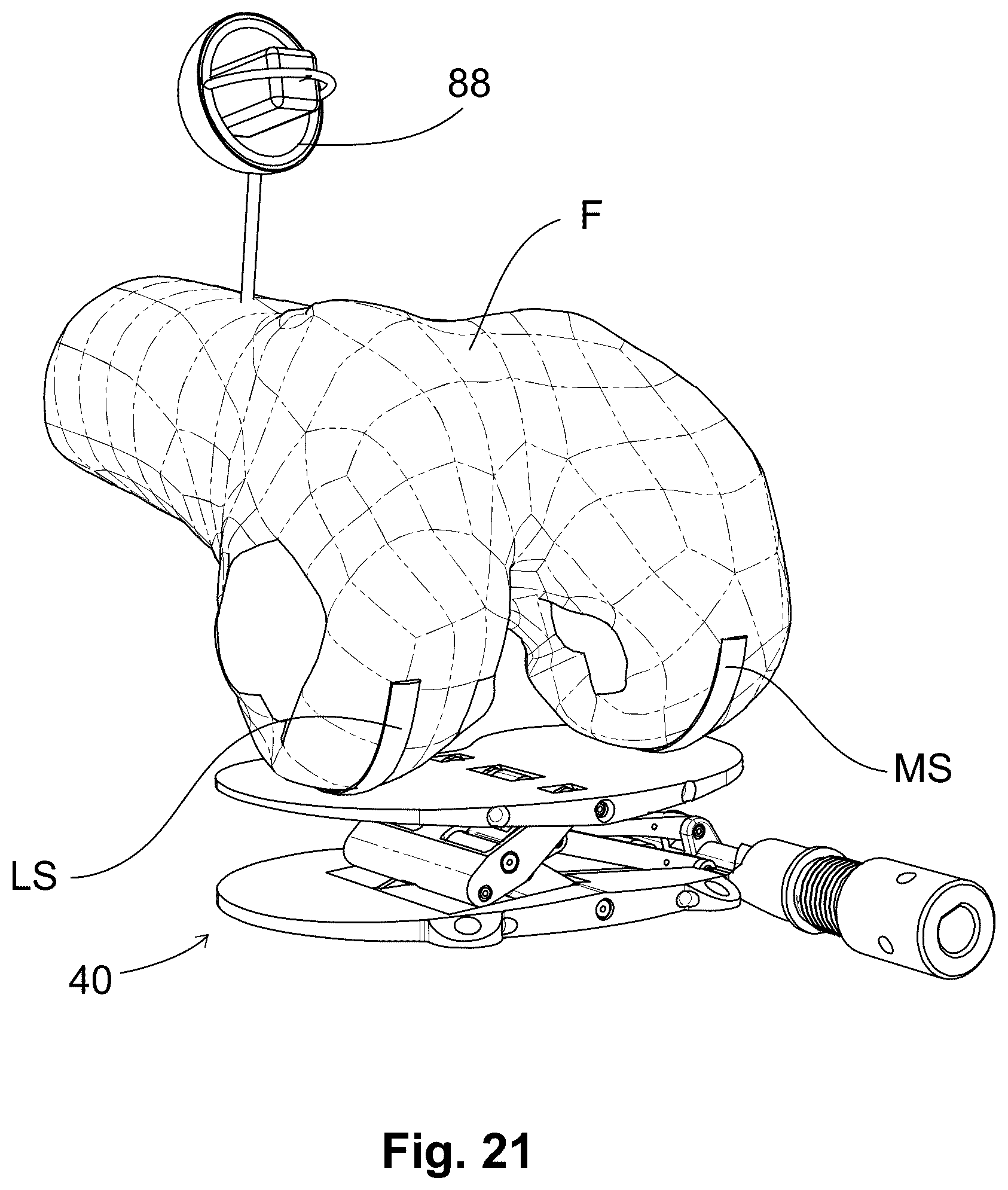 Patent US12303405 Figure 12 – Knee arthroplasty method