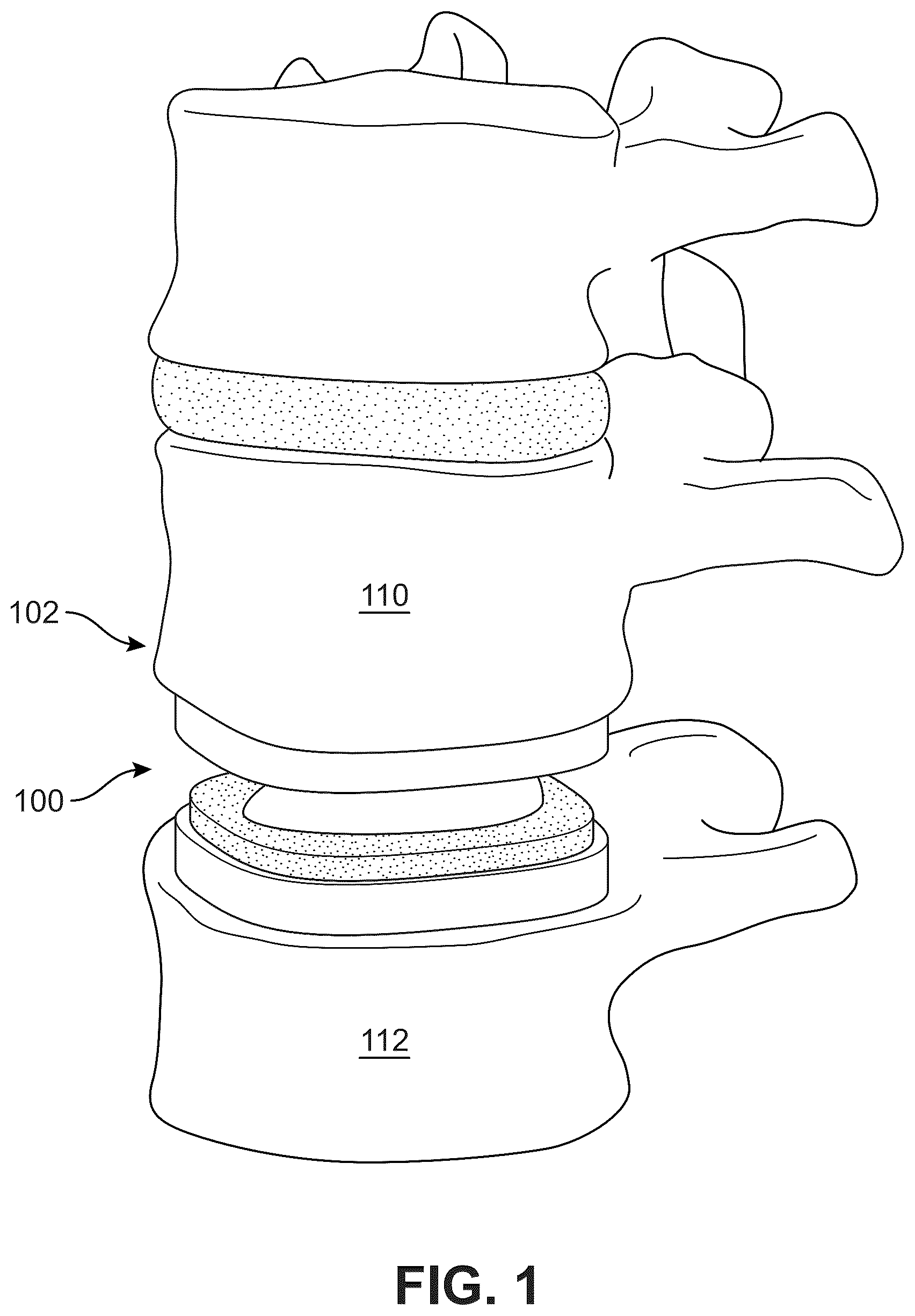 Patent US12303406 Figure 1 – Method of implanting an artificial disc replacement device