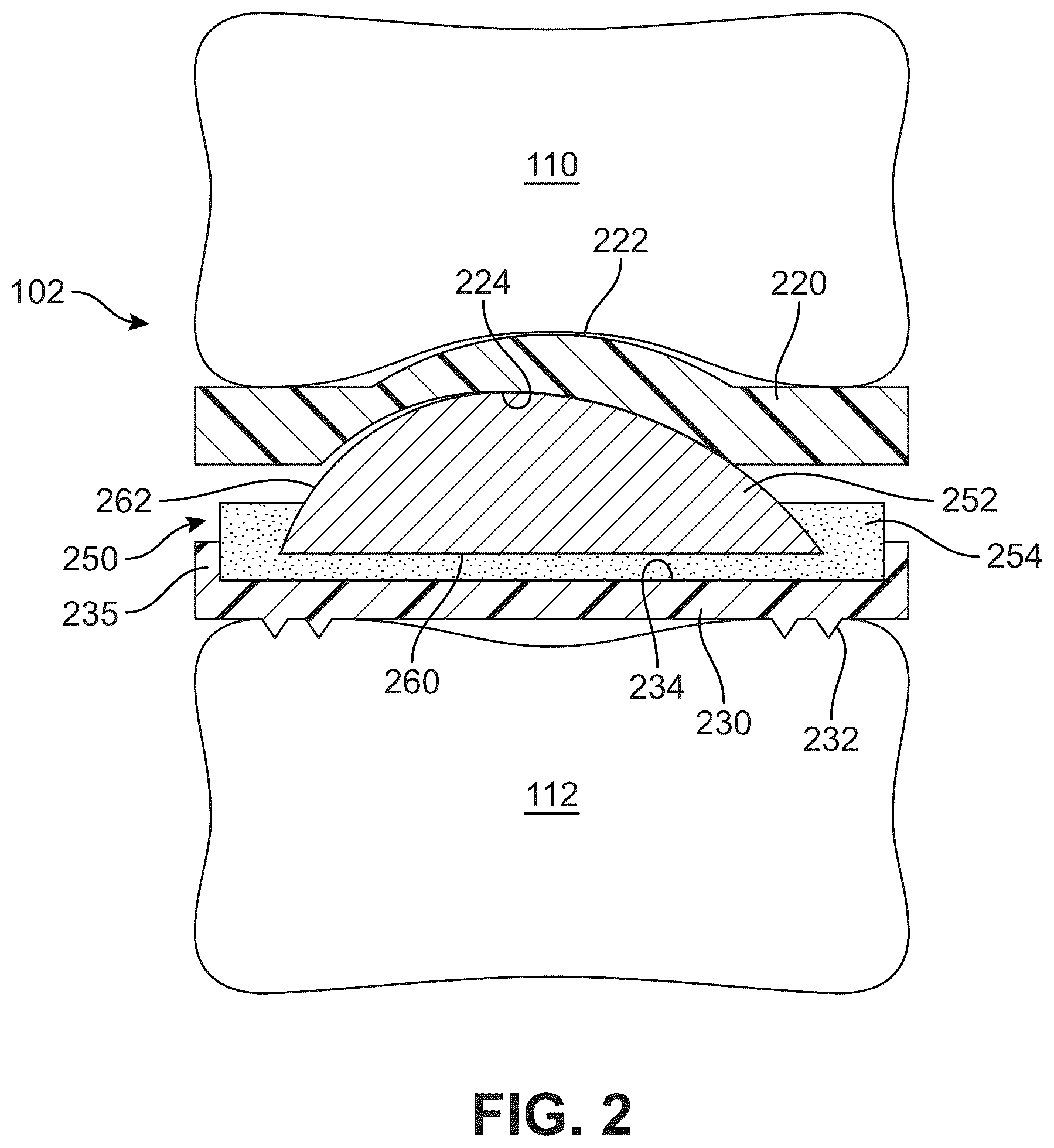 Patent US12303406 Figure 2 – Method of implanting an artificial disc replacement device