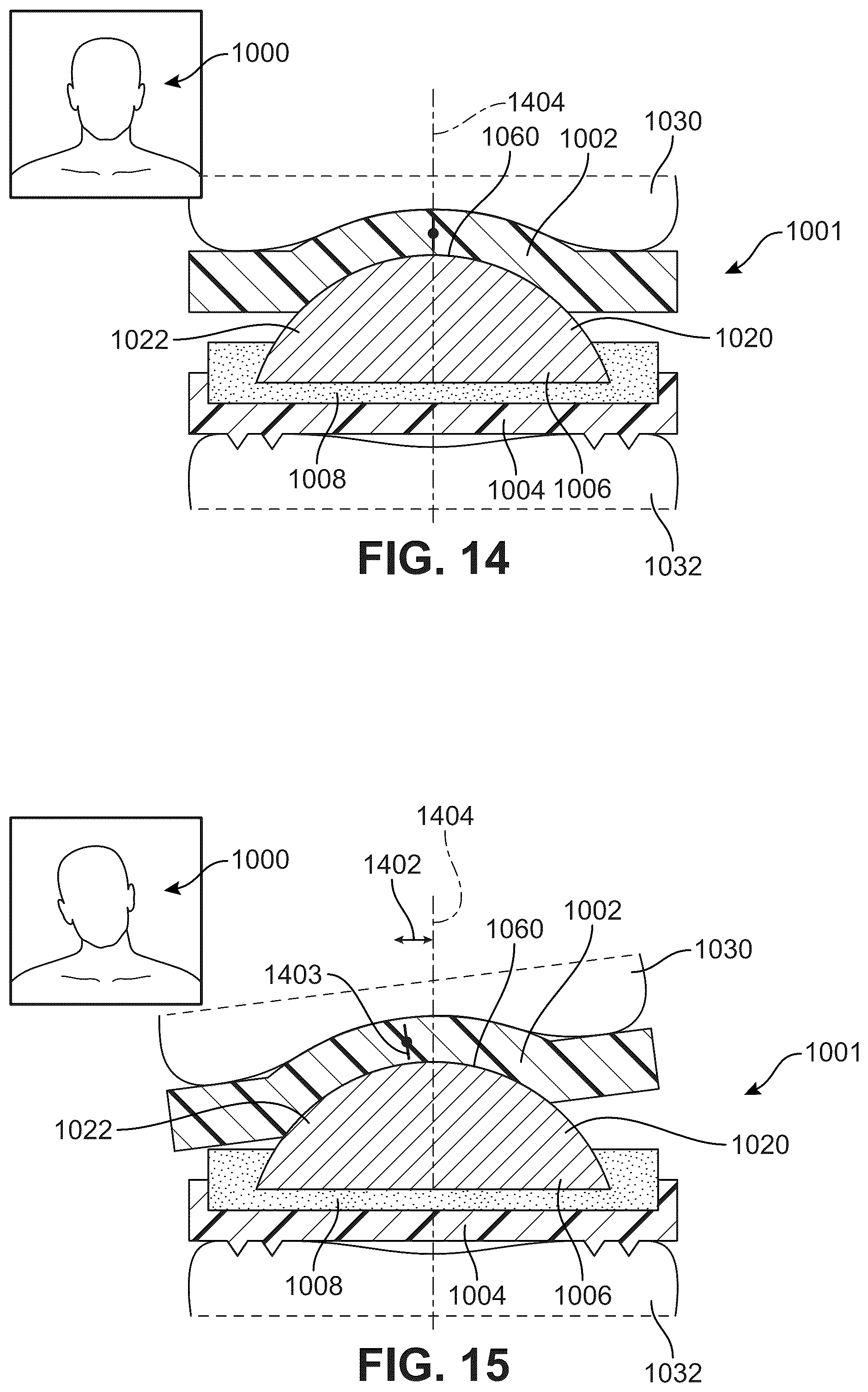 Patent US12303406 Figure 11 – Method of implanting an artificial disc replacement device