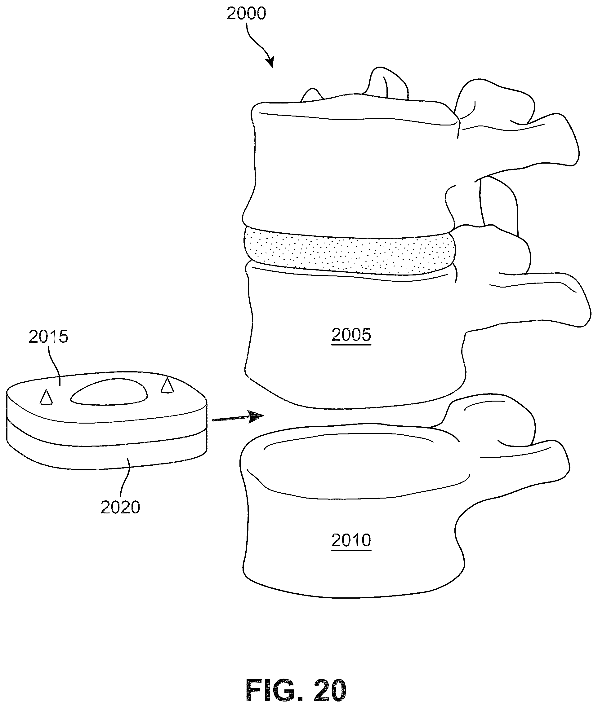 Patent US12303406 Figure 14 – Method of implanting an artificial disc replacement device