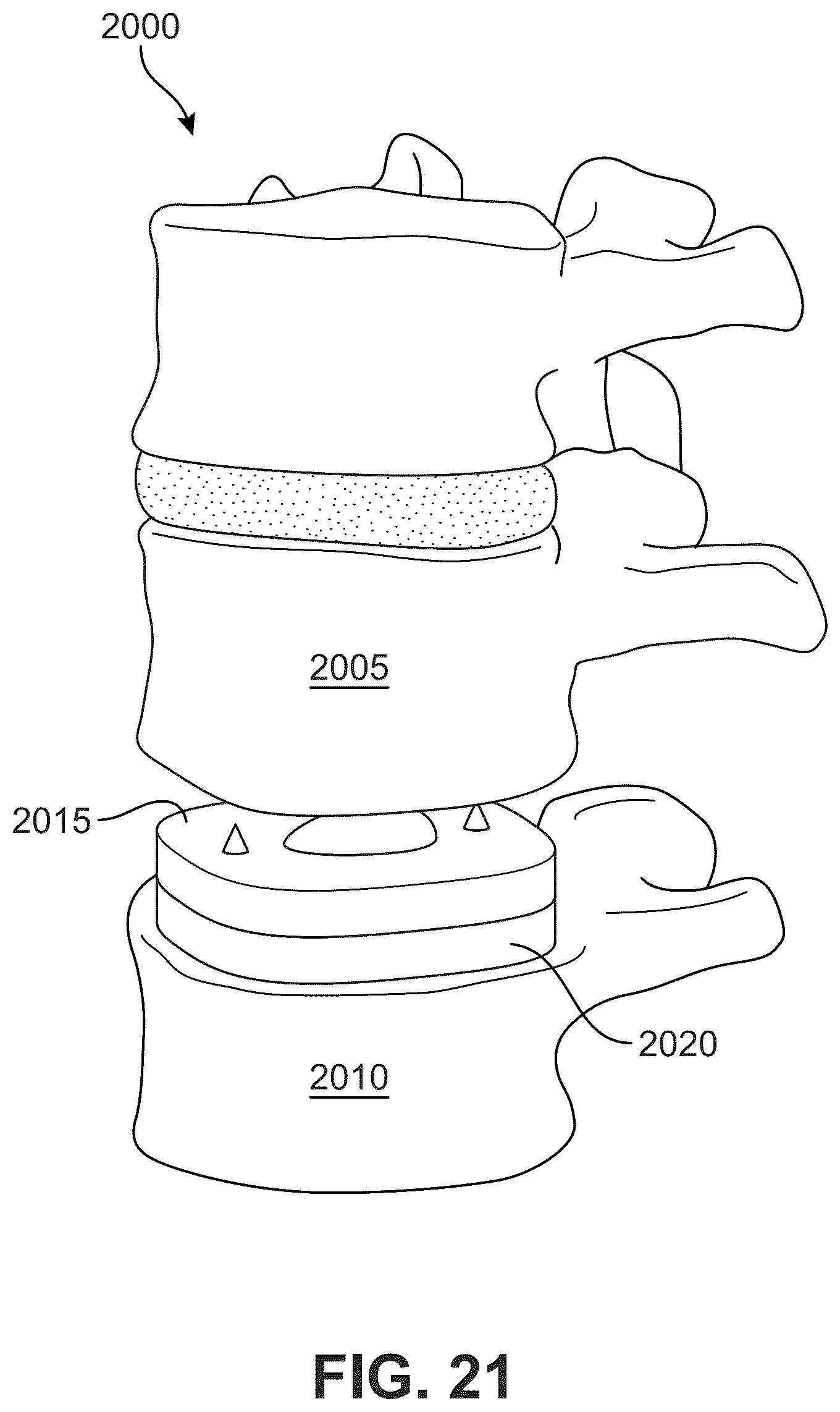 Patent US12303406 Figure 15 – Method of implanting an artificial disc replacement device