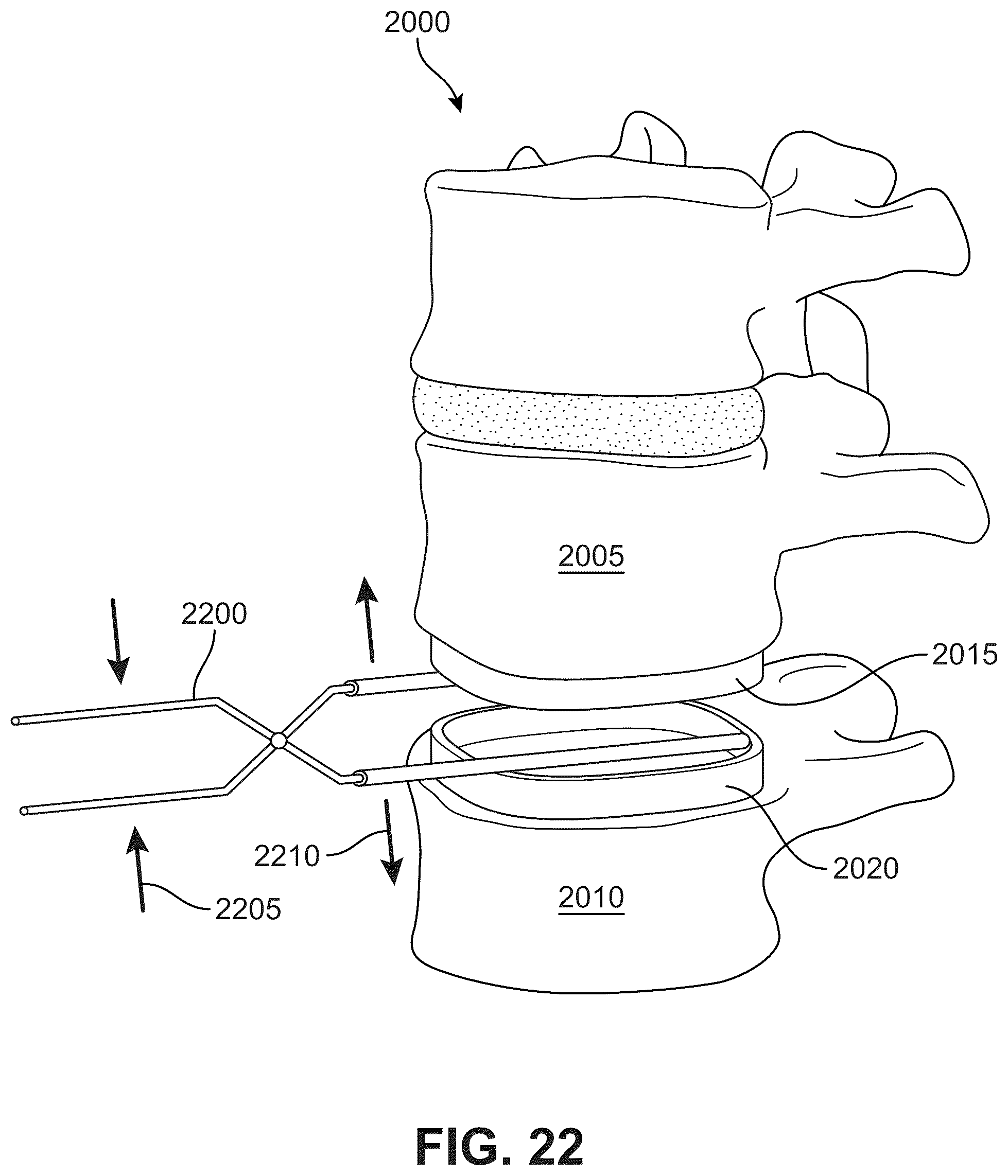 Patent US12303406 Figure 16 – Method of implanting an artificial disc replacement device