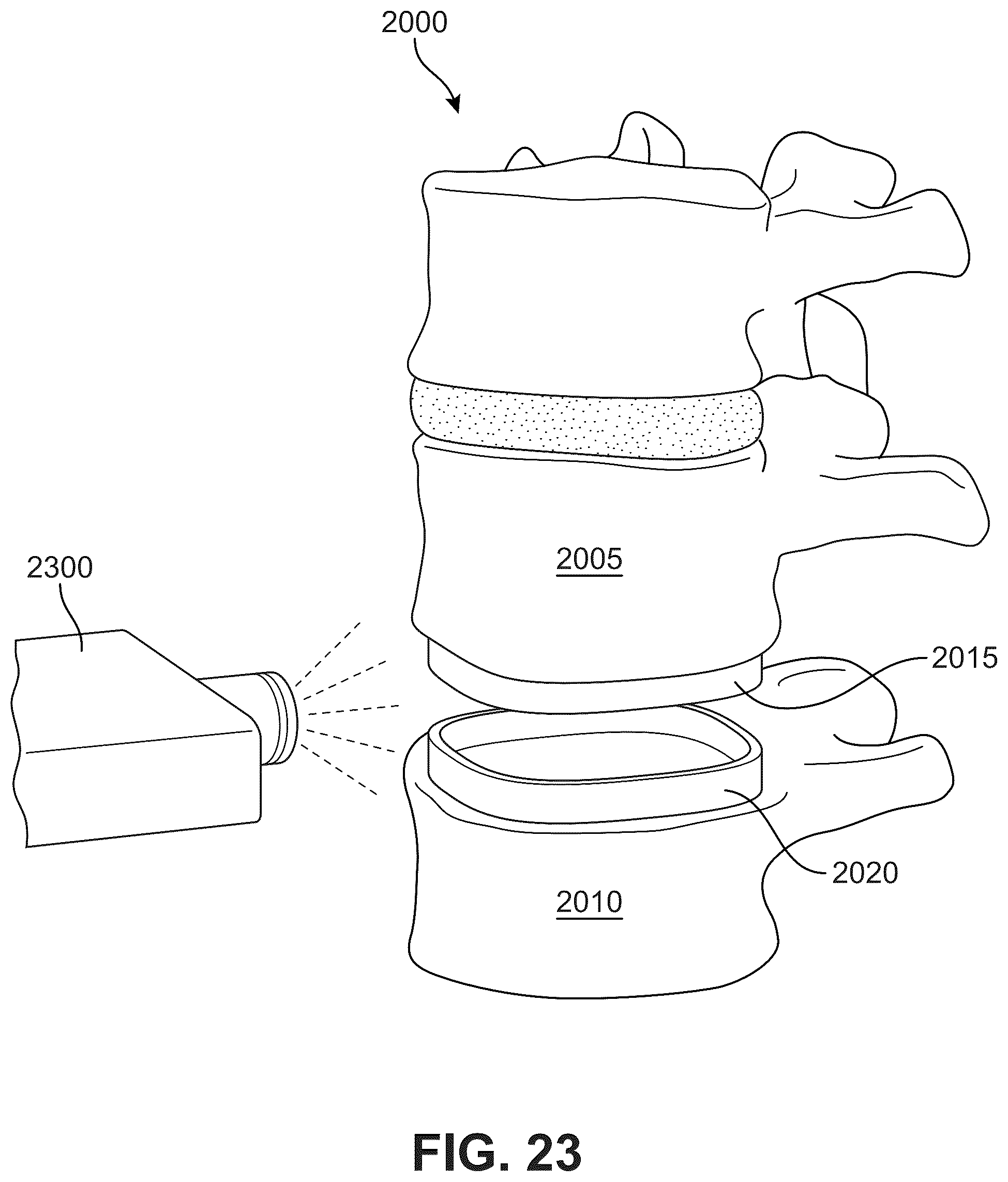 Patent US12303406 Figure 17 – Method of implanting an artificial disc replacement device