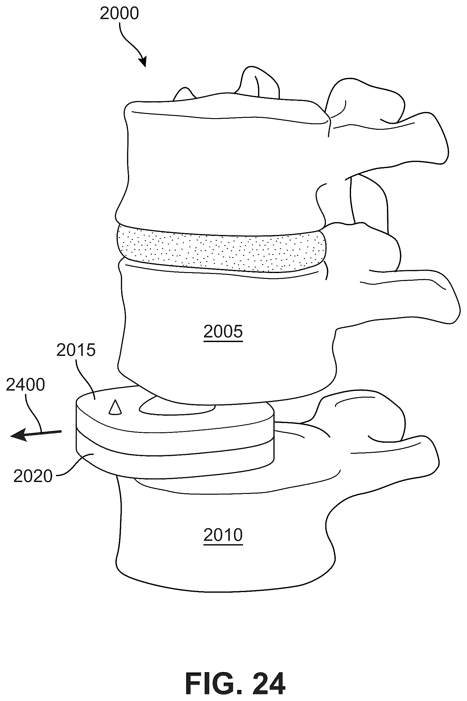 Patent US12303406 Figure 18 – Method of implanting an artificial disc replacement device