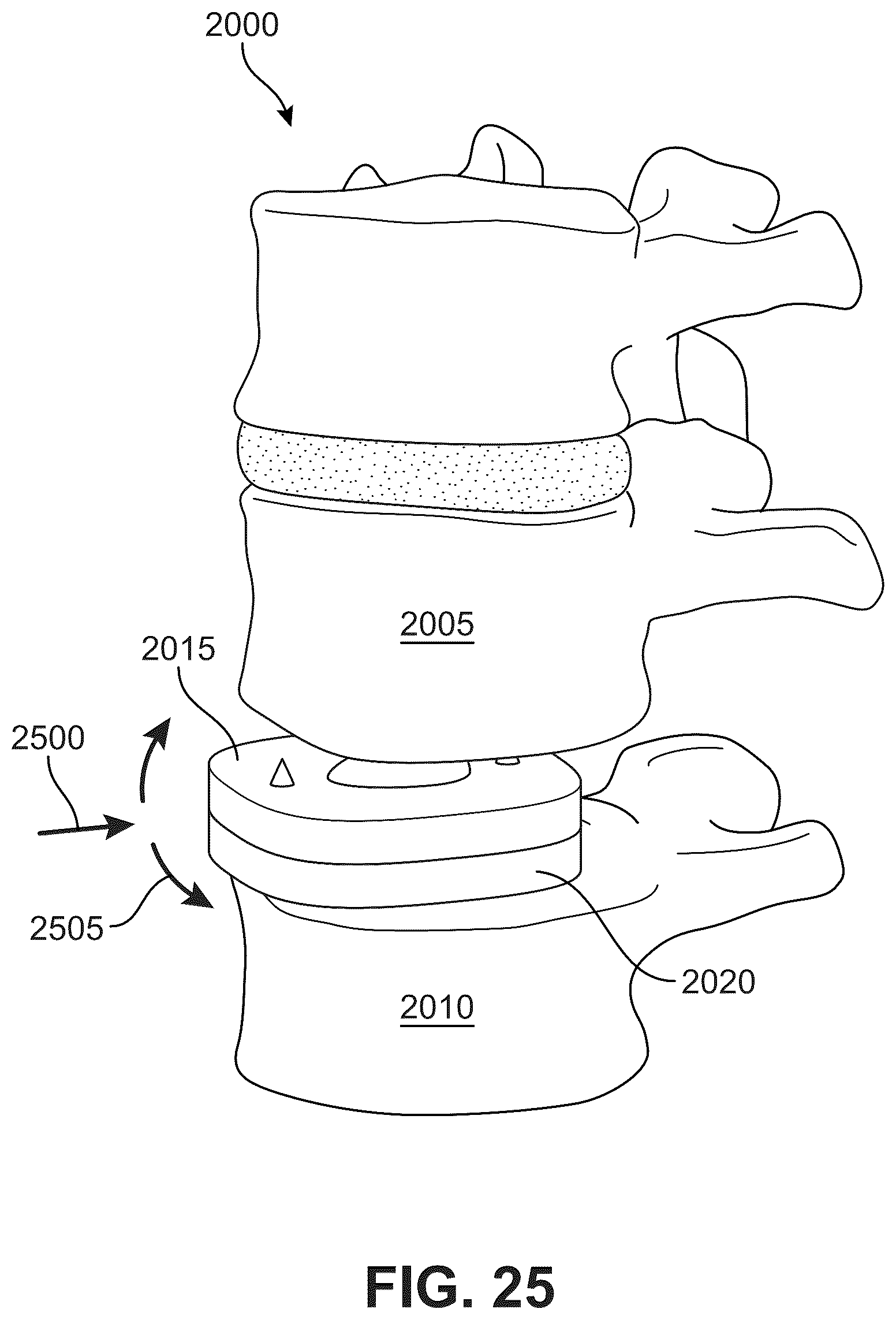 Patent US12303406 Figure 19 – Method of implanting an artificial disc replacement device