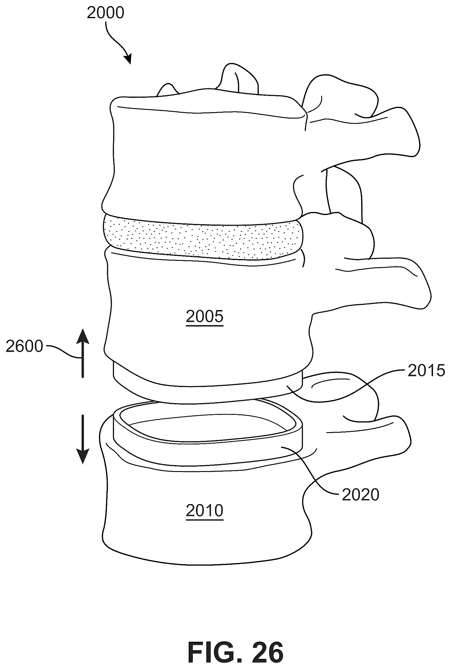 Patent US12303406 Figure 20 – Method of implanting an artificial disc replacement device