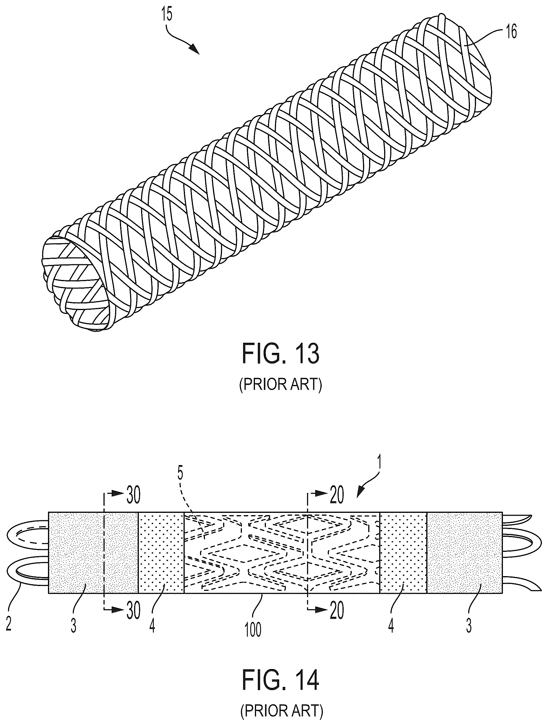 Patent US12303410 Figure 10 – Stent device with stent covering with regions of differing porosity
