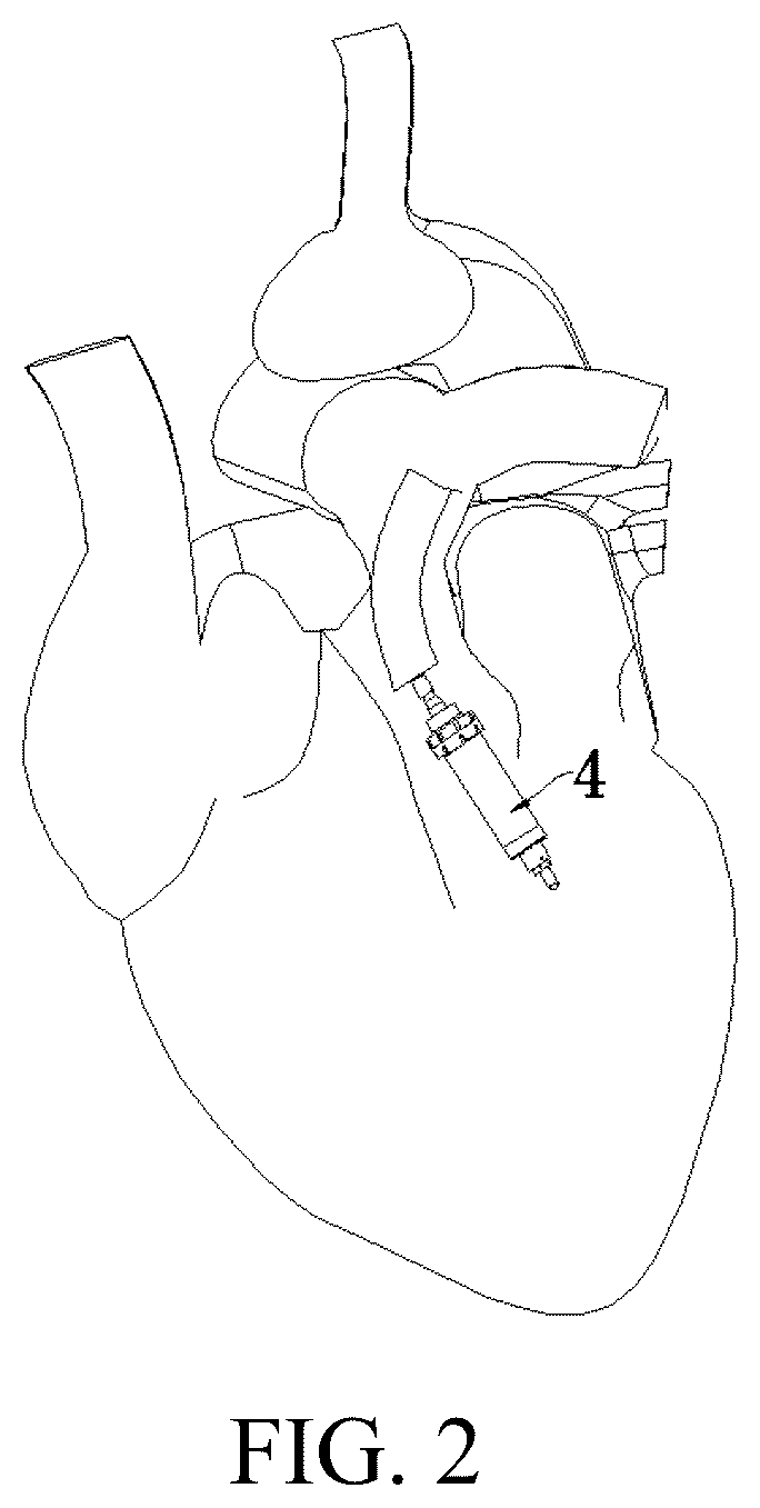 Patent US12303411 Figure 2 – Left ventricular outflow tract stent and delivery system