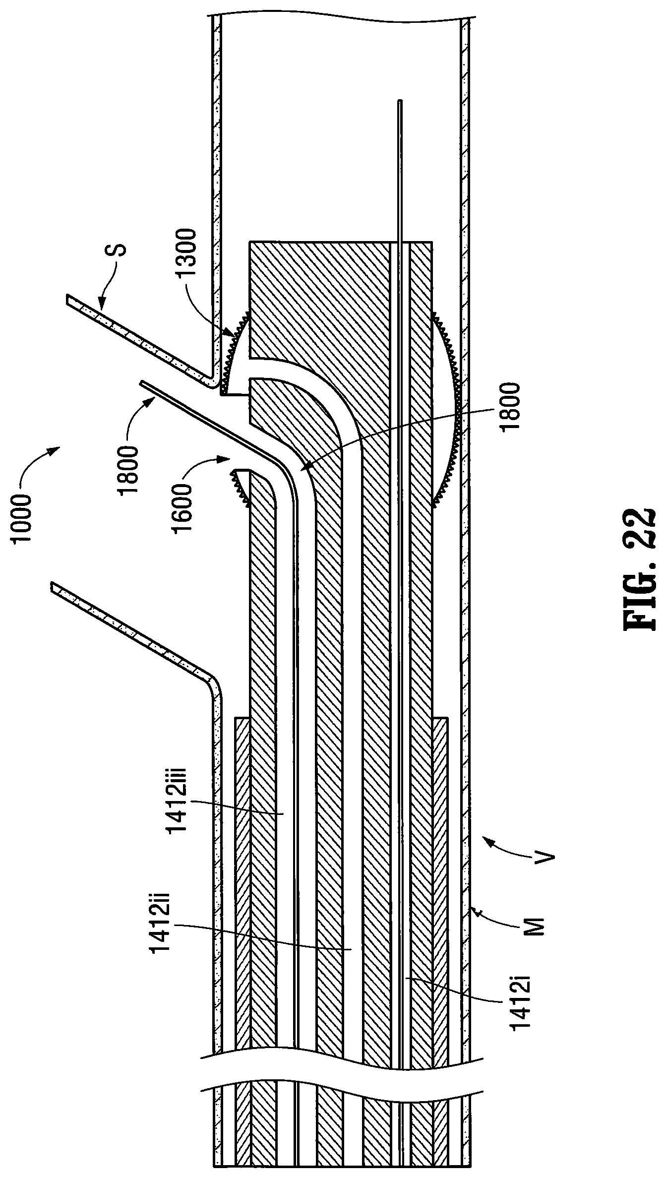 Patent US12303412 Figure 14 – Orientable implantable device and method