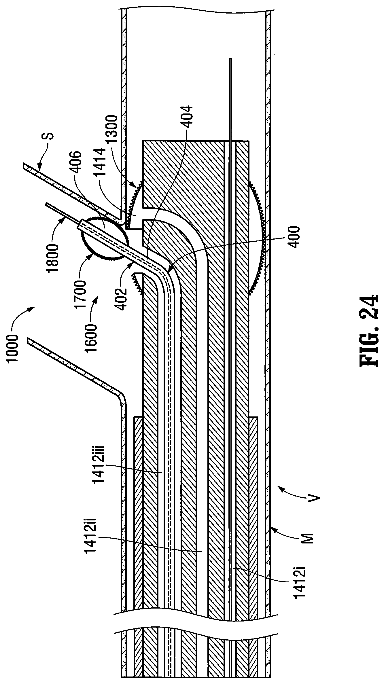 Patent US12303412 Figure 16 – Orientable implantable device and method