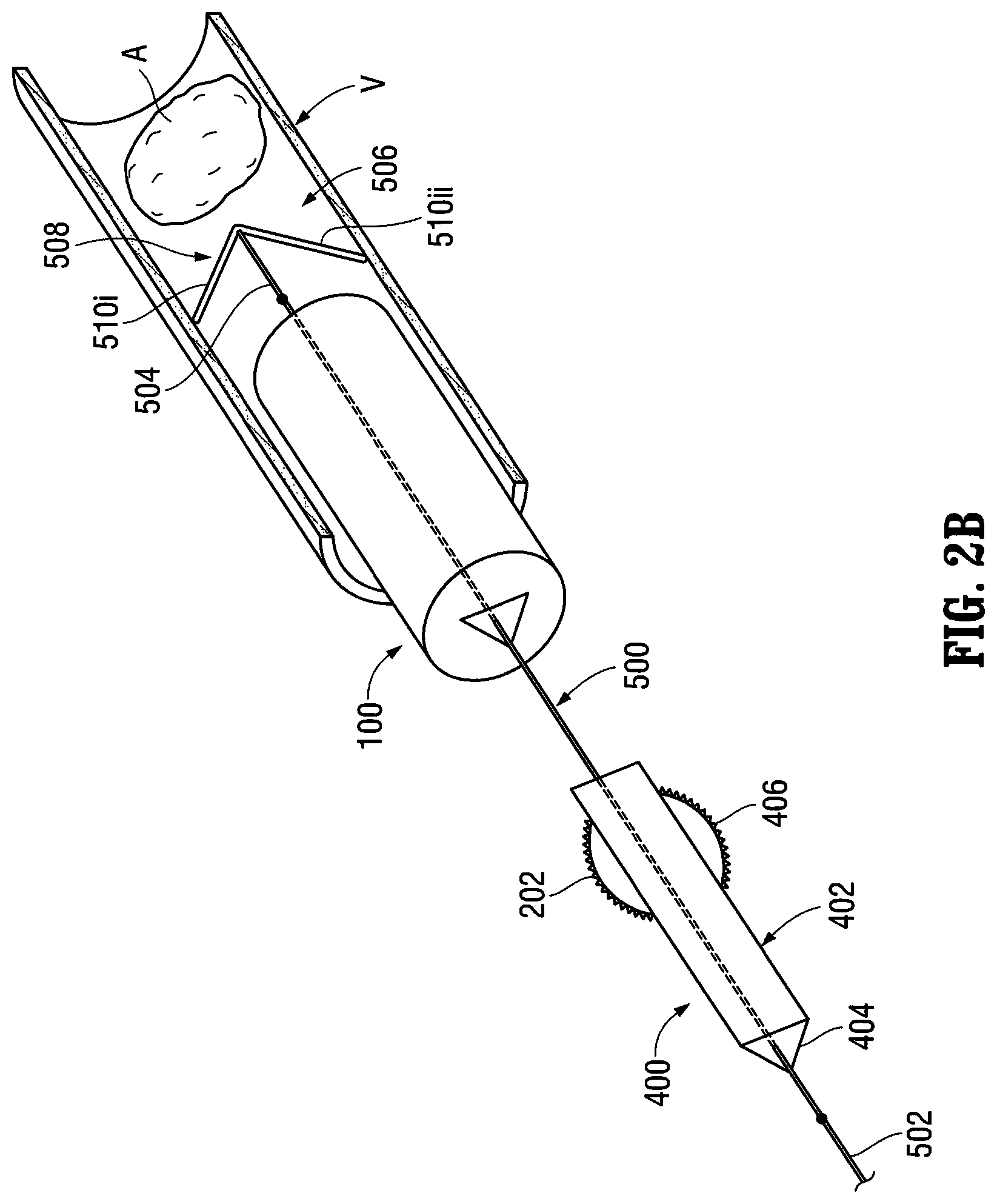 Patent US12303413 Figure 3 – Orientable implantable device and method