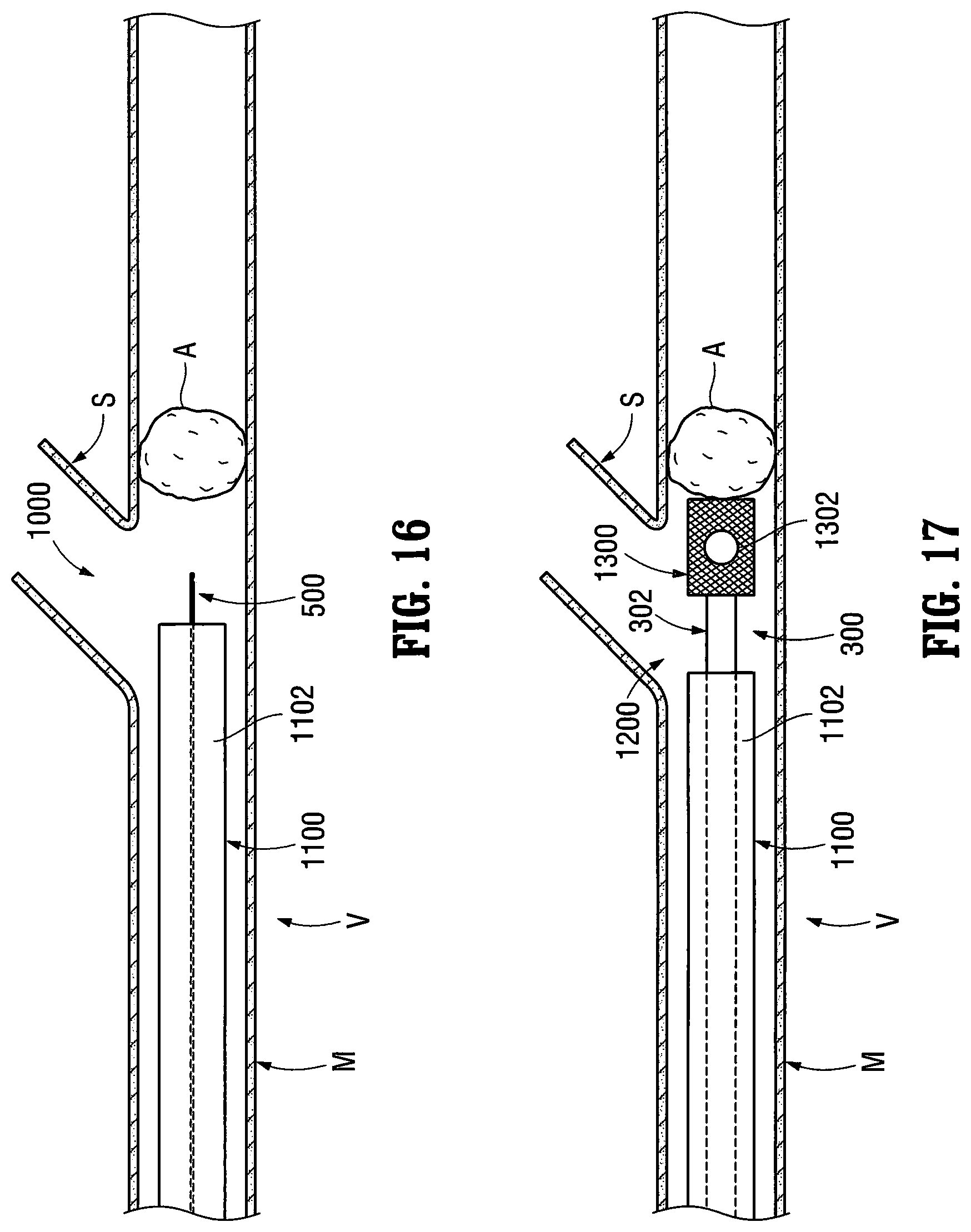 Patent US12303413 Figure 11 – Orientable implantable device and method