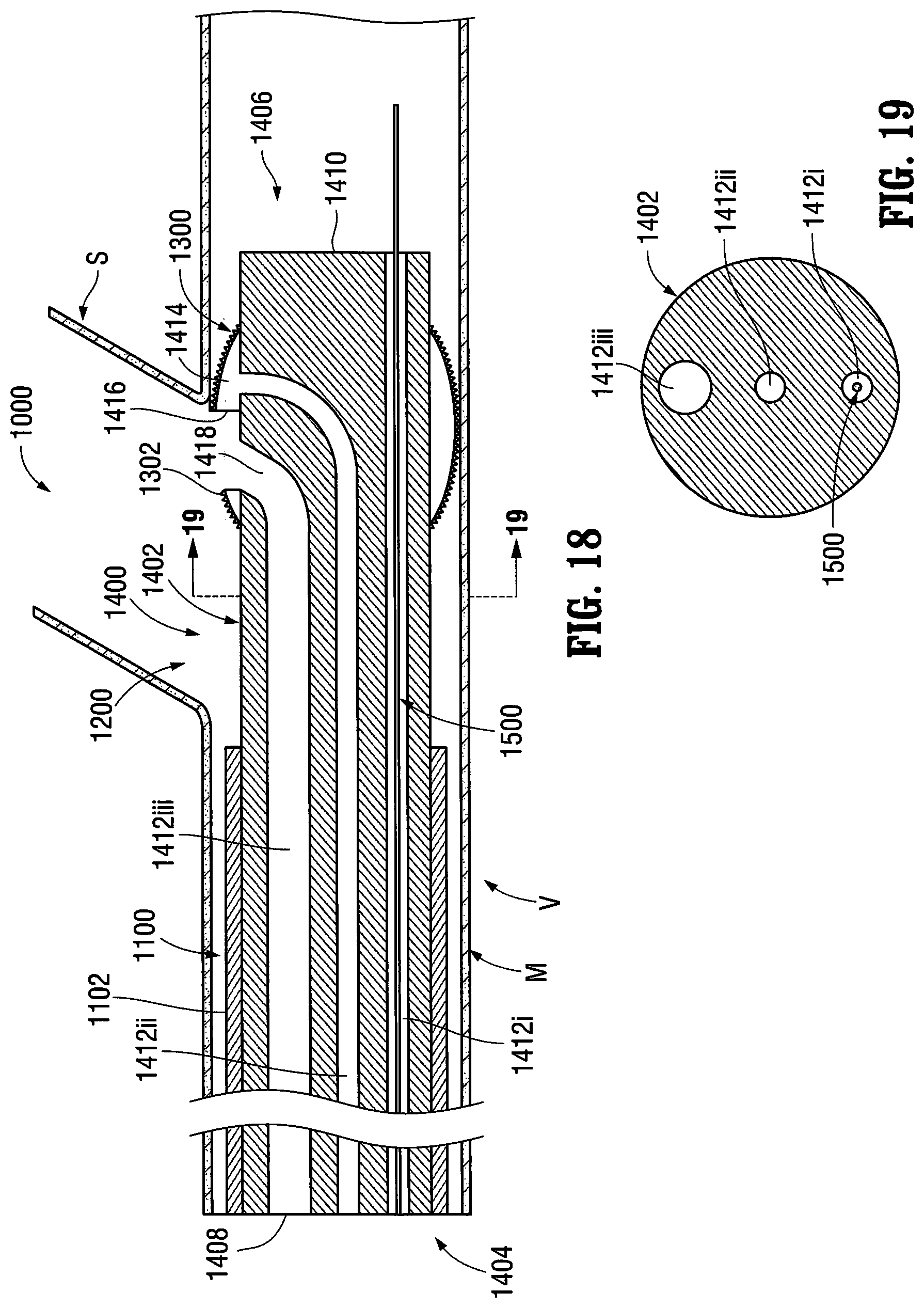 Patent US12303413 Figure 12 – Orientable implantable device and method