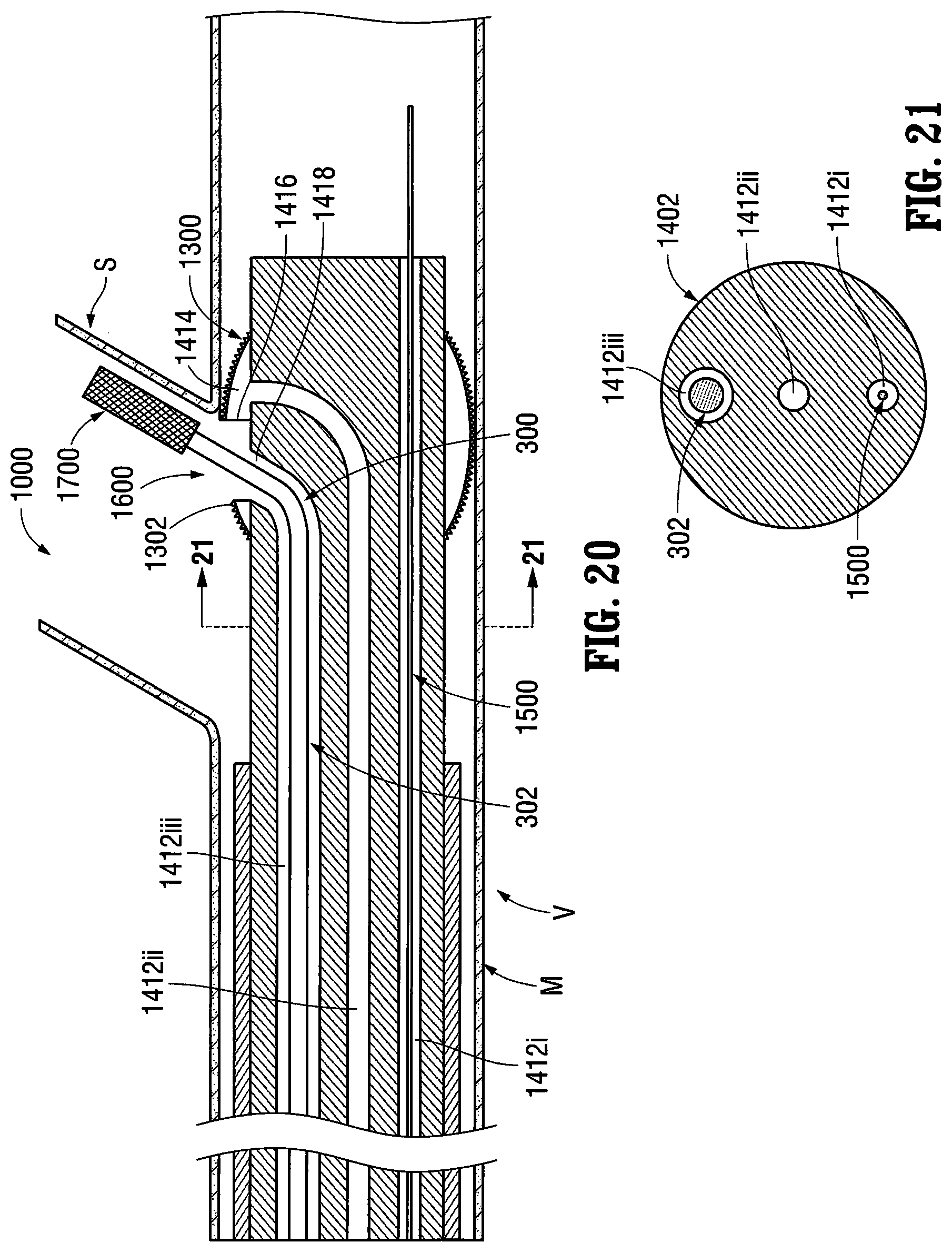 Patent US12303413 Figure 13 – Orientable implantable device and method