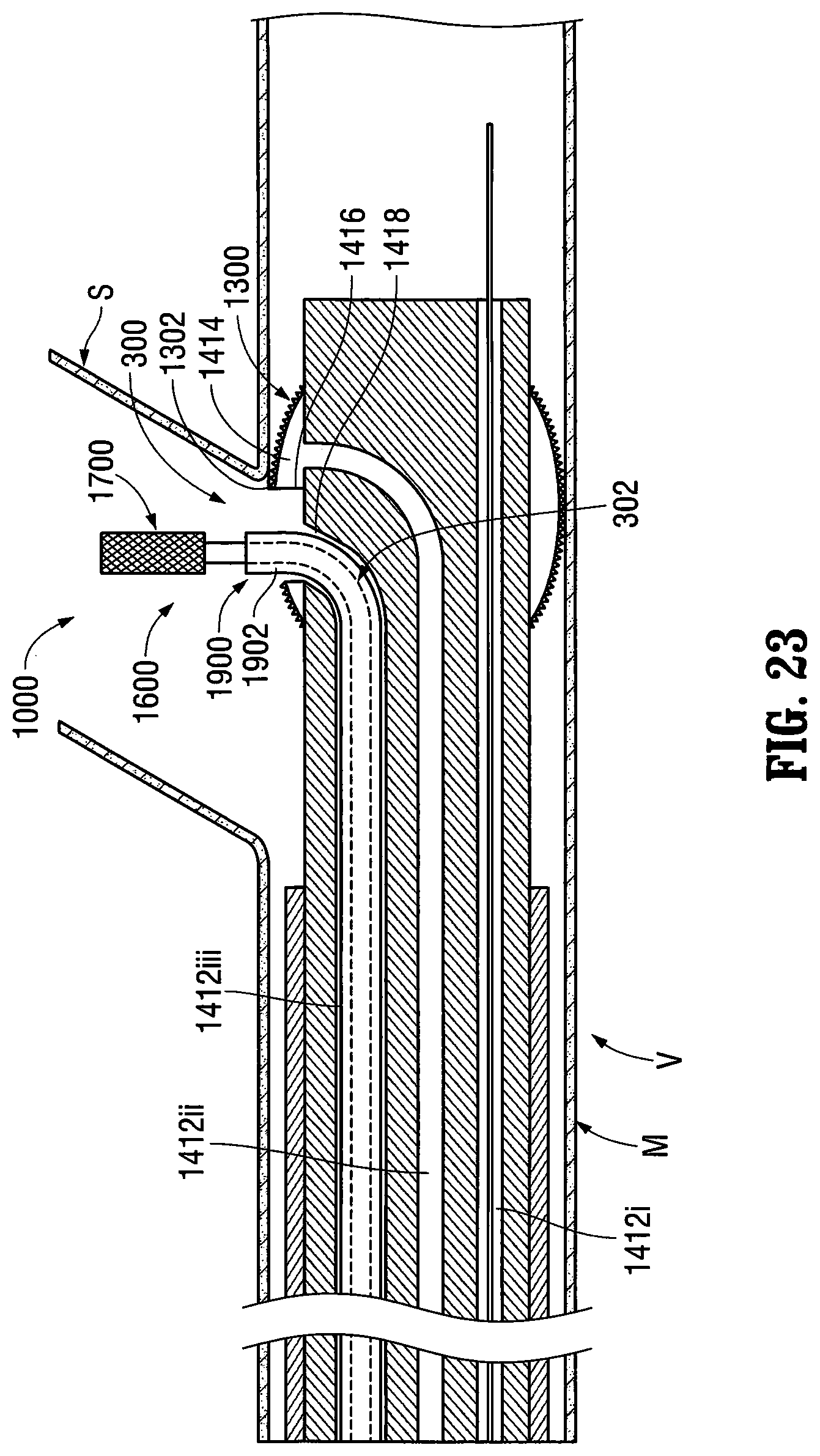 Patent US12303413 Figure 15 – Orientable implantable device and method
