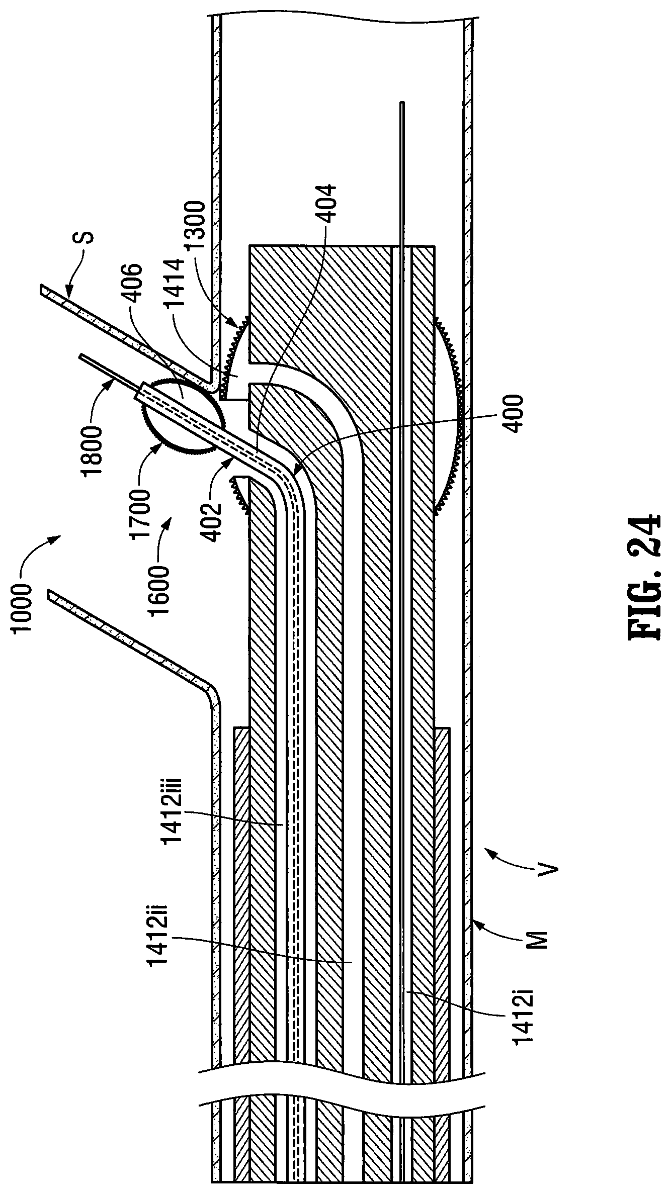 Patent US12303413 Figure 16 – Orientable implantable device and method