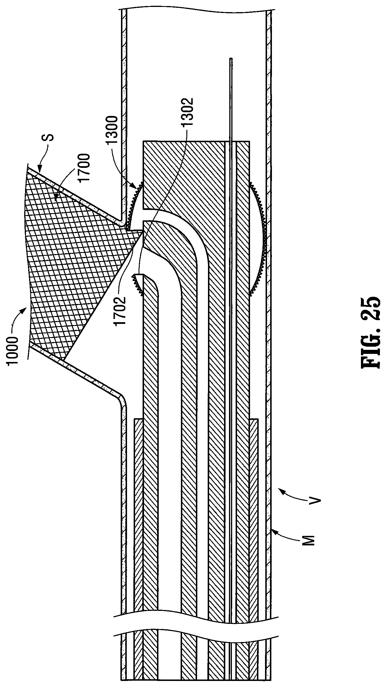 Patent US12303413 Figure 17 – Orientable implantable device and method