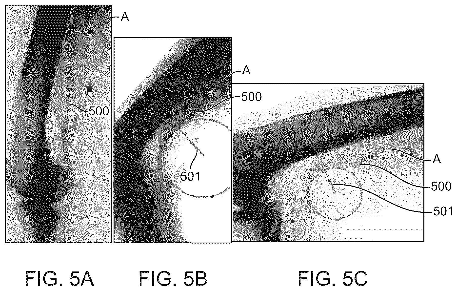 Patent US12303414 Figure 5 – Absorbable intravascular devices that shorten upon expansion creating space for vascular movement