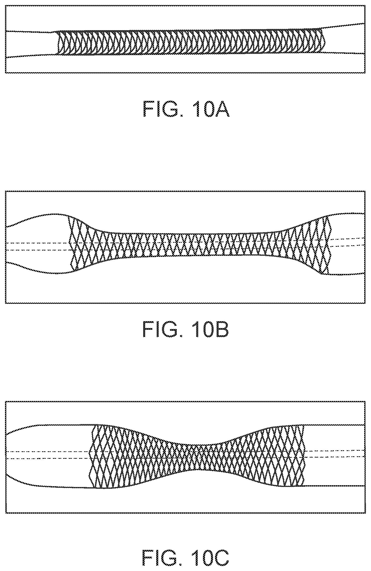 Patent US12303414 Figure 10 – Absorbable intravascular devices that shorten upon expansion creating space for vascular movement