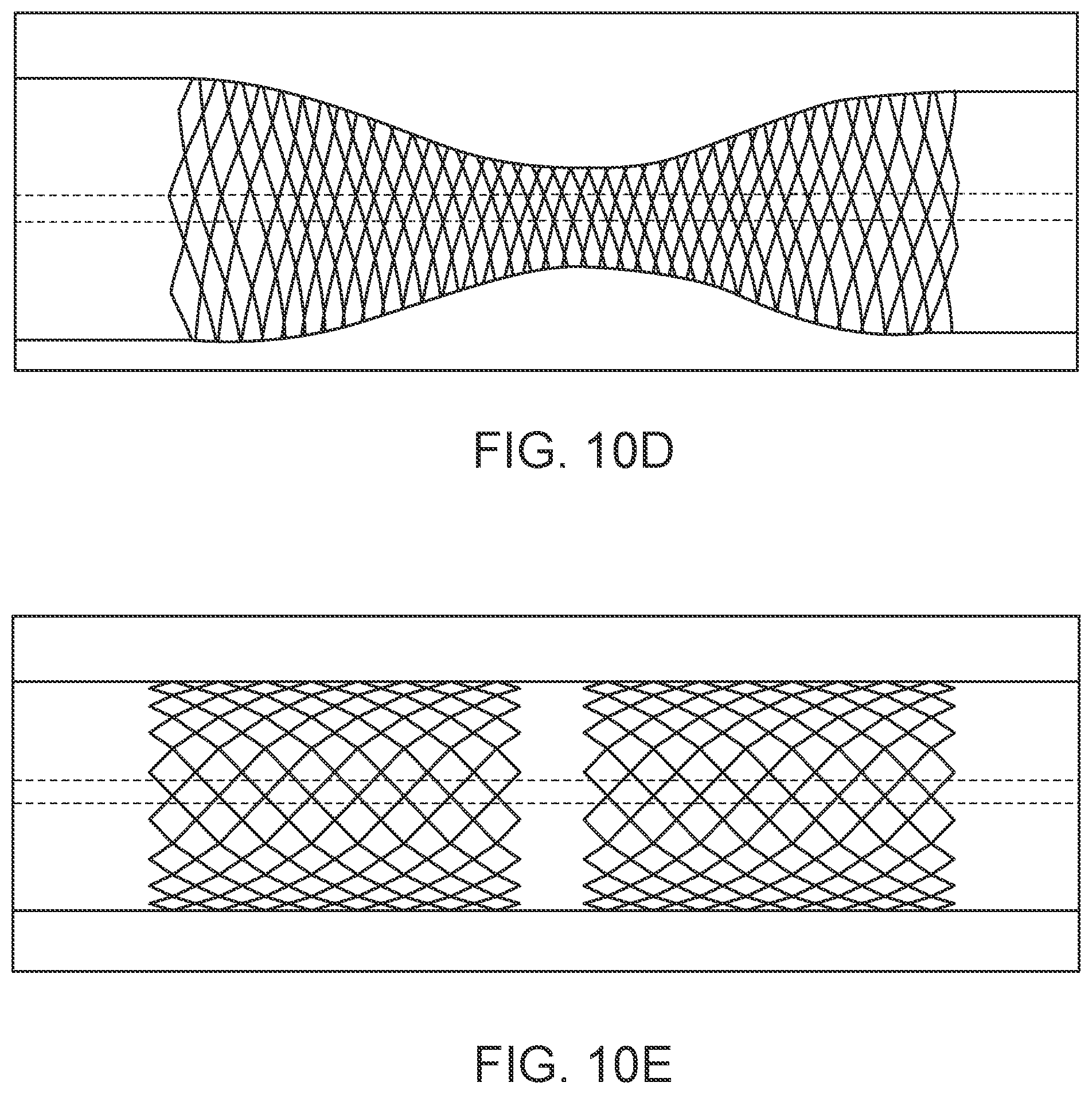 Patent US12303414 Figure 11 – Absorbable intravascular devices that shorten upon expansion creating space for vascular movement