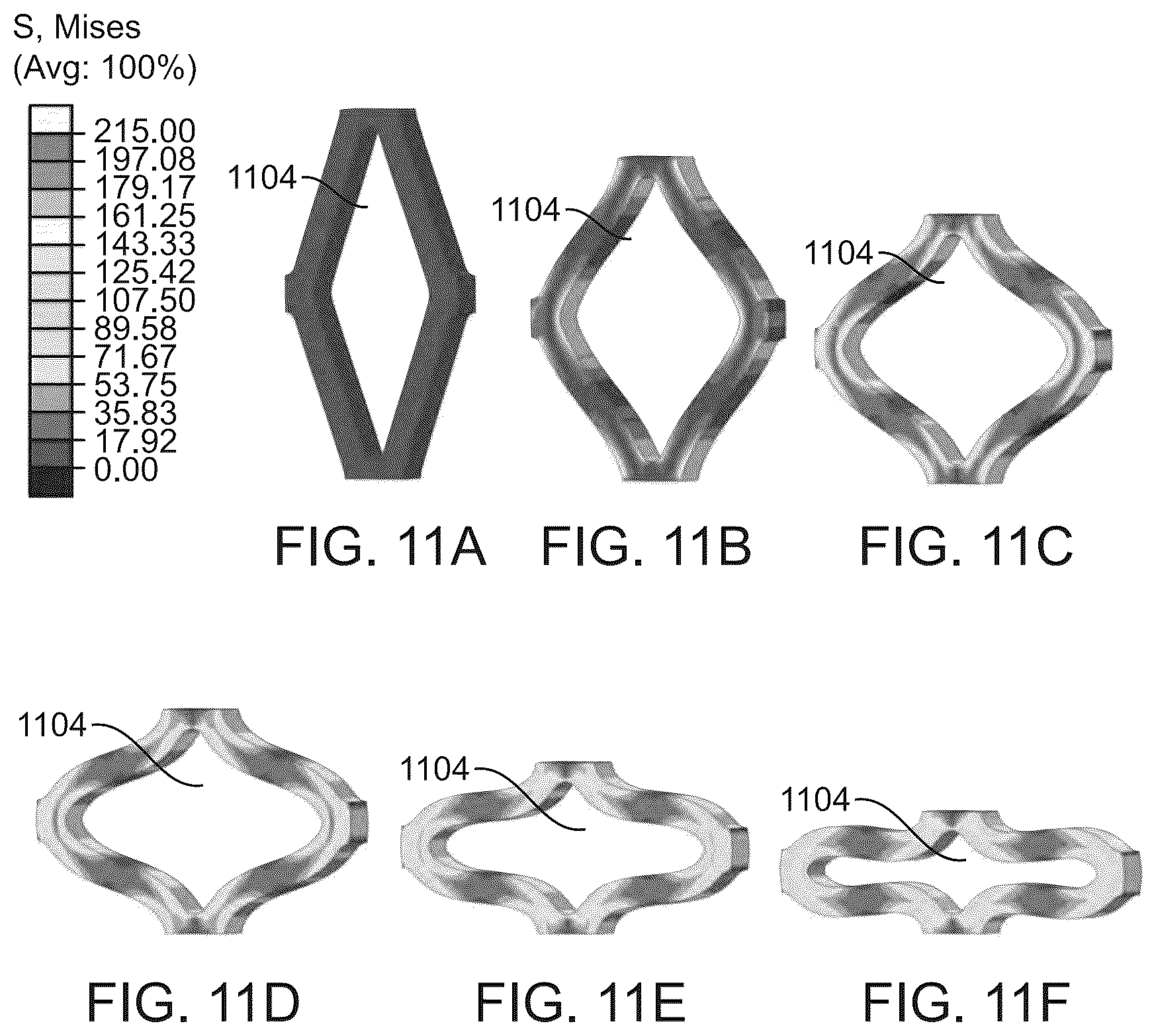 Patent US12303414 Figure 12 – Absorbable intravascular devices that shorten upon expansion creating space for vascular movement