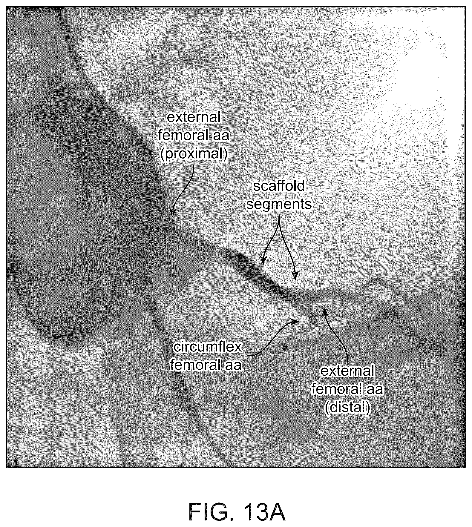 Patent US12303414 Figure 14 – Absorbable intravascular devices that shorten upon expansion creating space for vascular movement