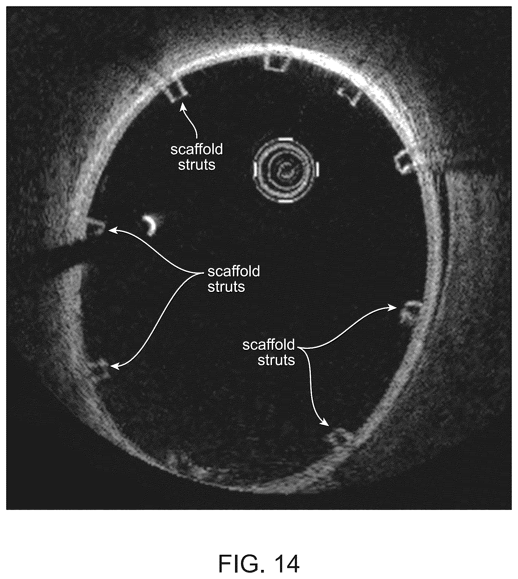 Patent US12303414 Figure 17 – Absorbable intravascular devices that shorten upon expansion creating space for vascular movement