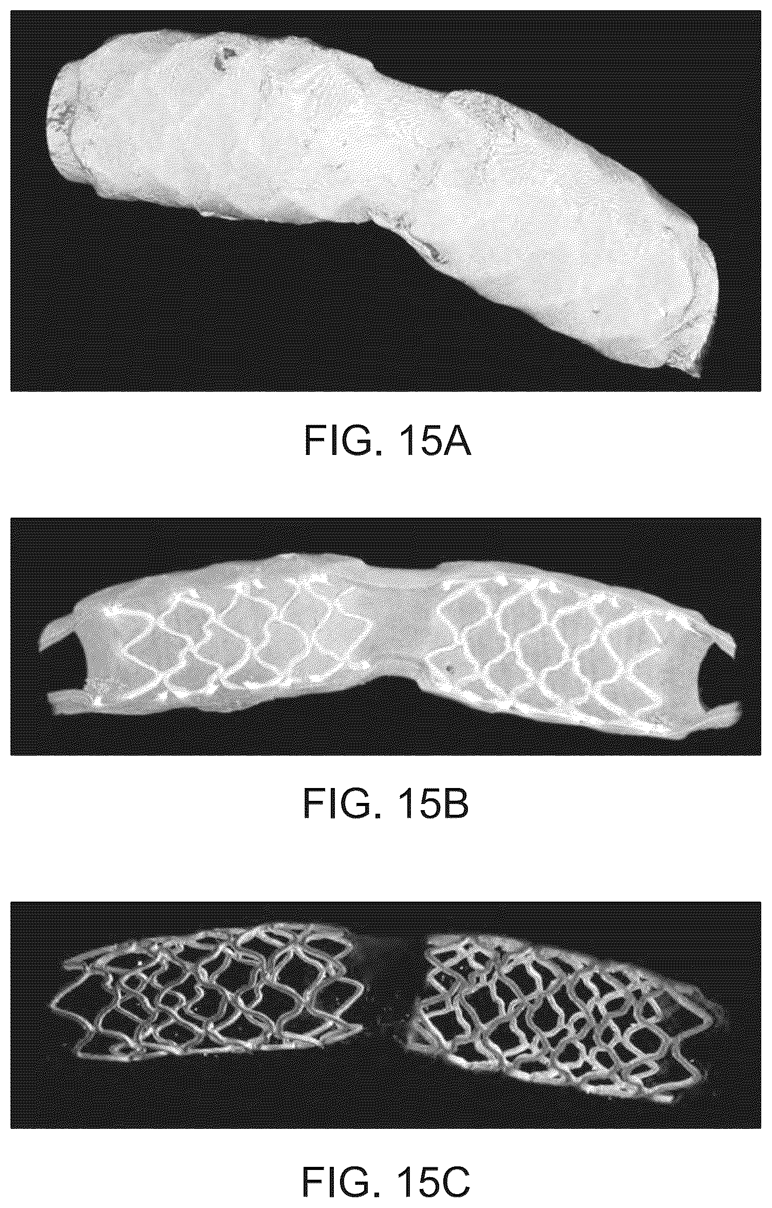 Patent US12303414 Figure 18 – Absorbable intravascular devices that shorten upon expansion creating space for vascular movement