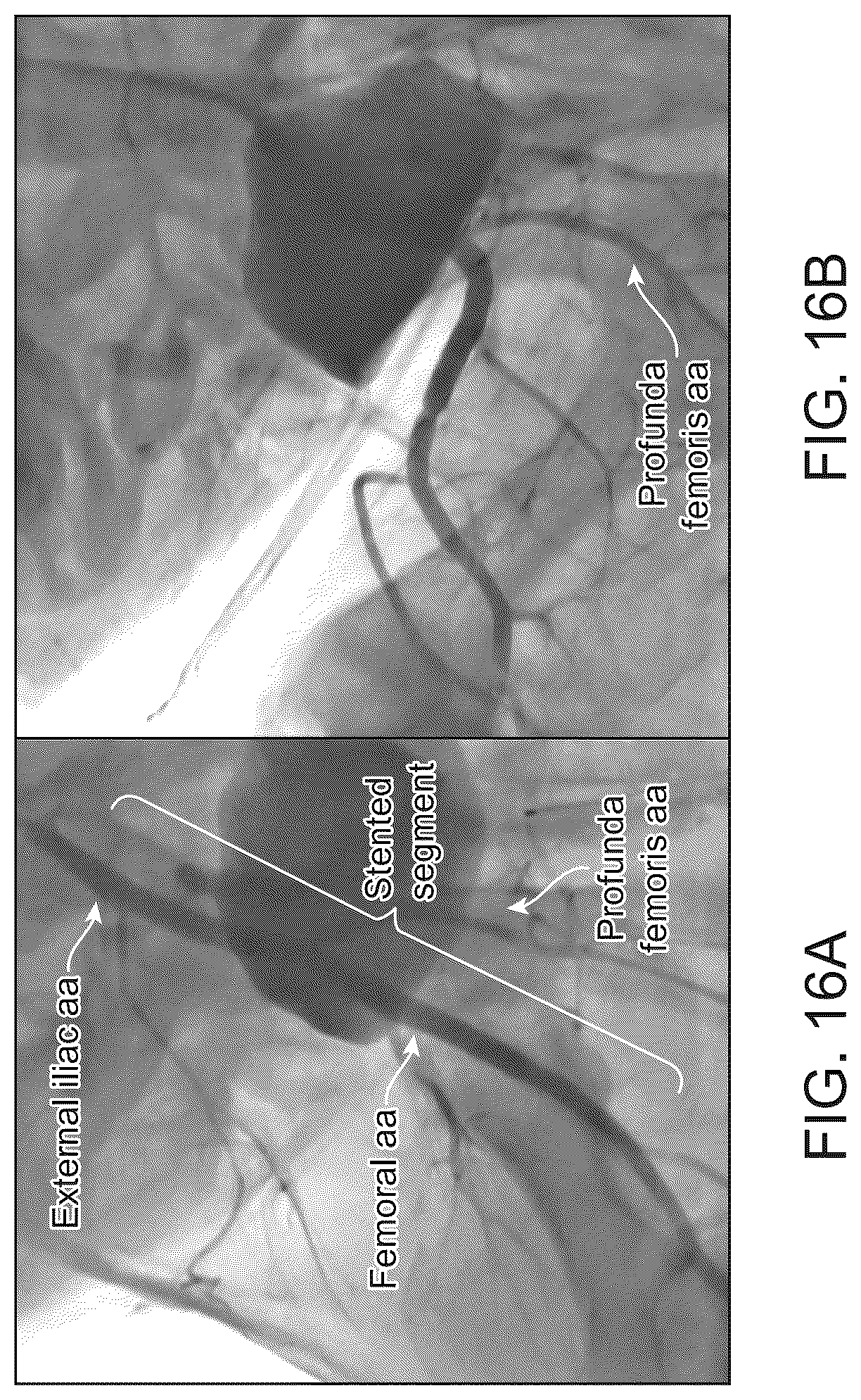 Patent US12303414 Figure 19 – Absorbable intravascular devices that shorten upon expansion creating space for vascular movement