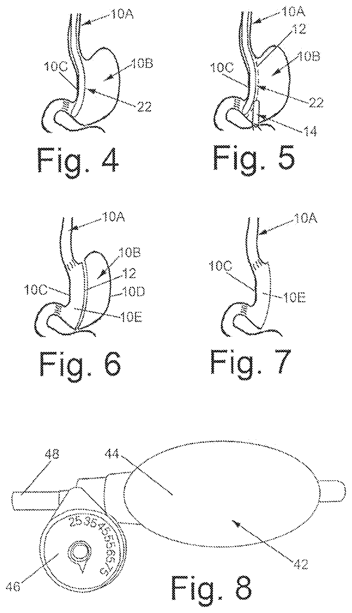 Patent US12303415 Figure 2 – Systems and methods for performing bariatric surgery
