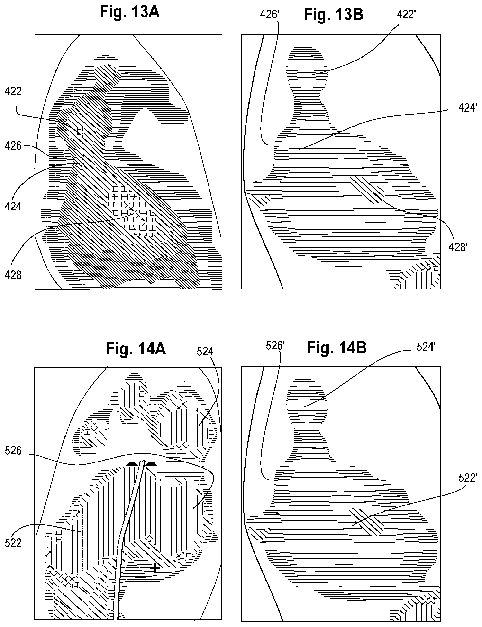 Patent US12303422 Figure 5 – Forefoot orthotic device