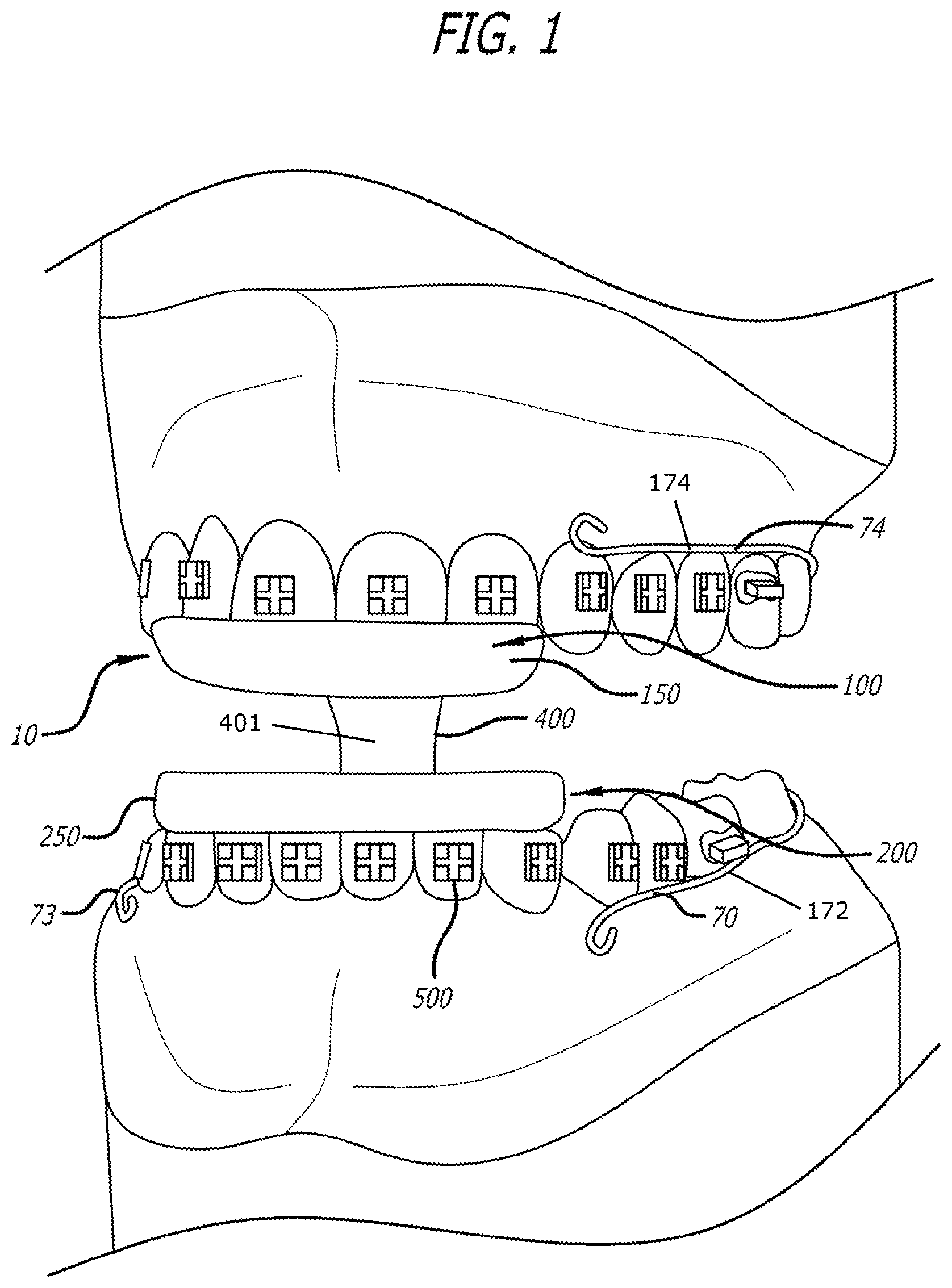 Patent US12303424 — Adjustable sleep apnea oral appliance for use with orthodontic braces — Figure 1