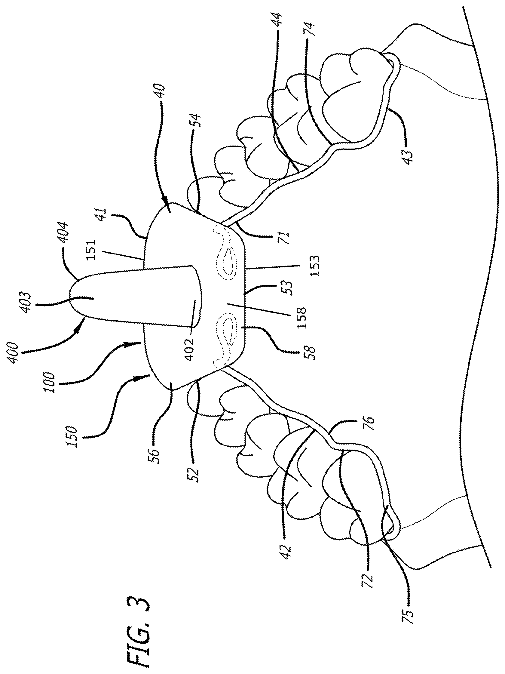 Patent US12303424 Figure 3 – Adjustable sleep apnea oral appliance for use with orthodontic braces