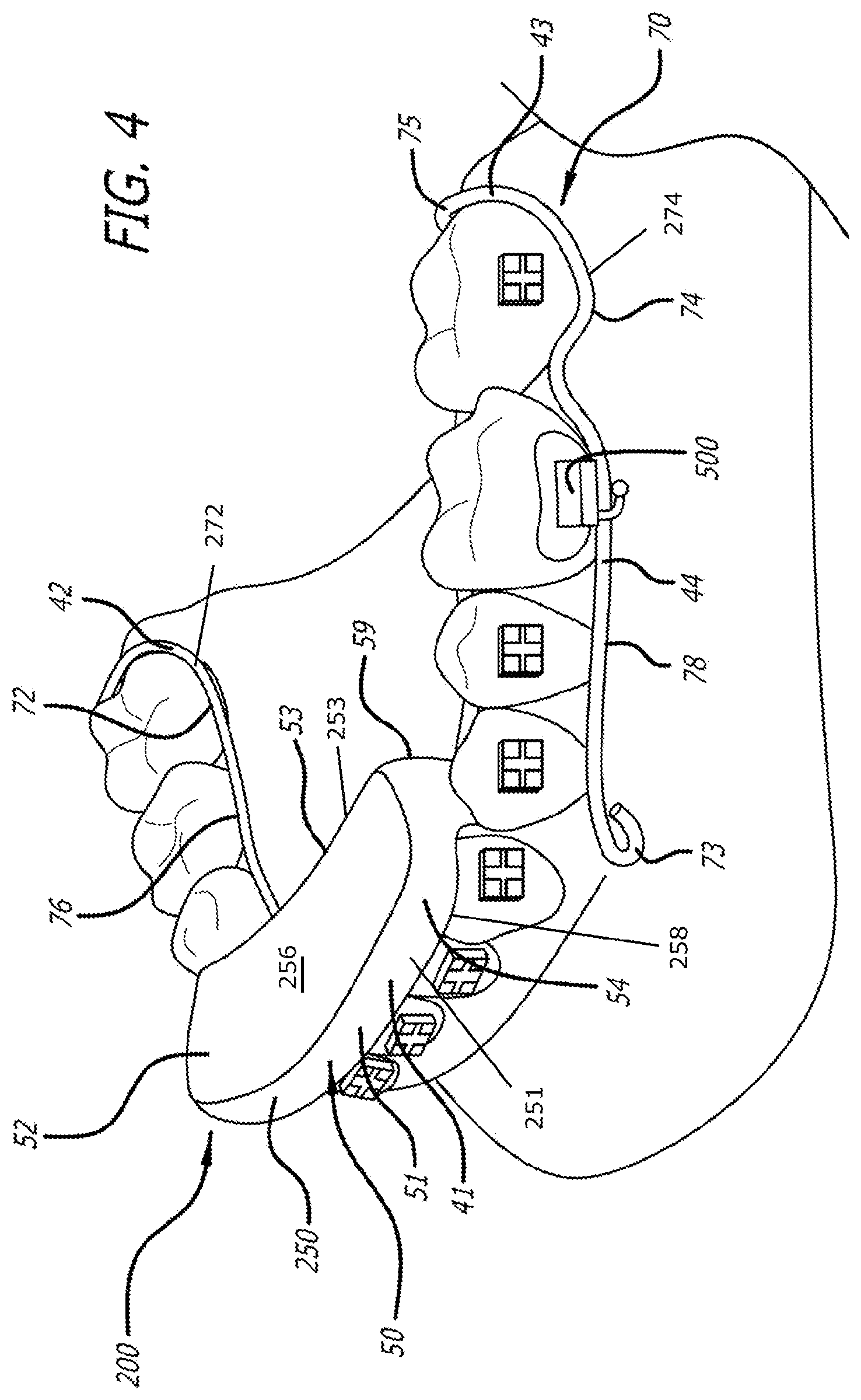 Patent US12303424 Figure 4 – Adjustable sleep apnea oral appliance for use with orthodontic braces