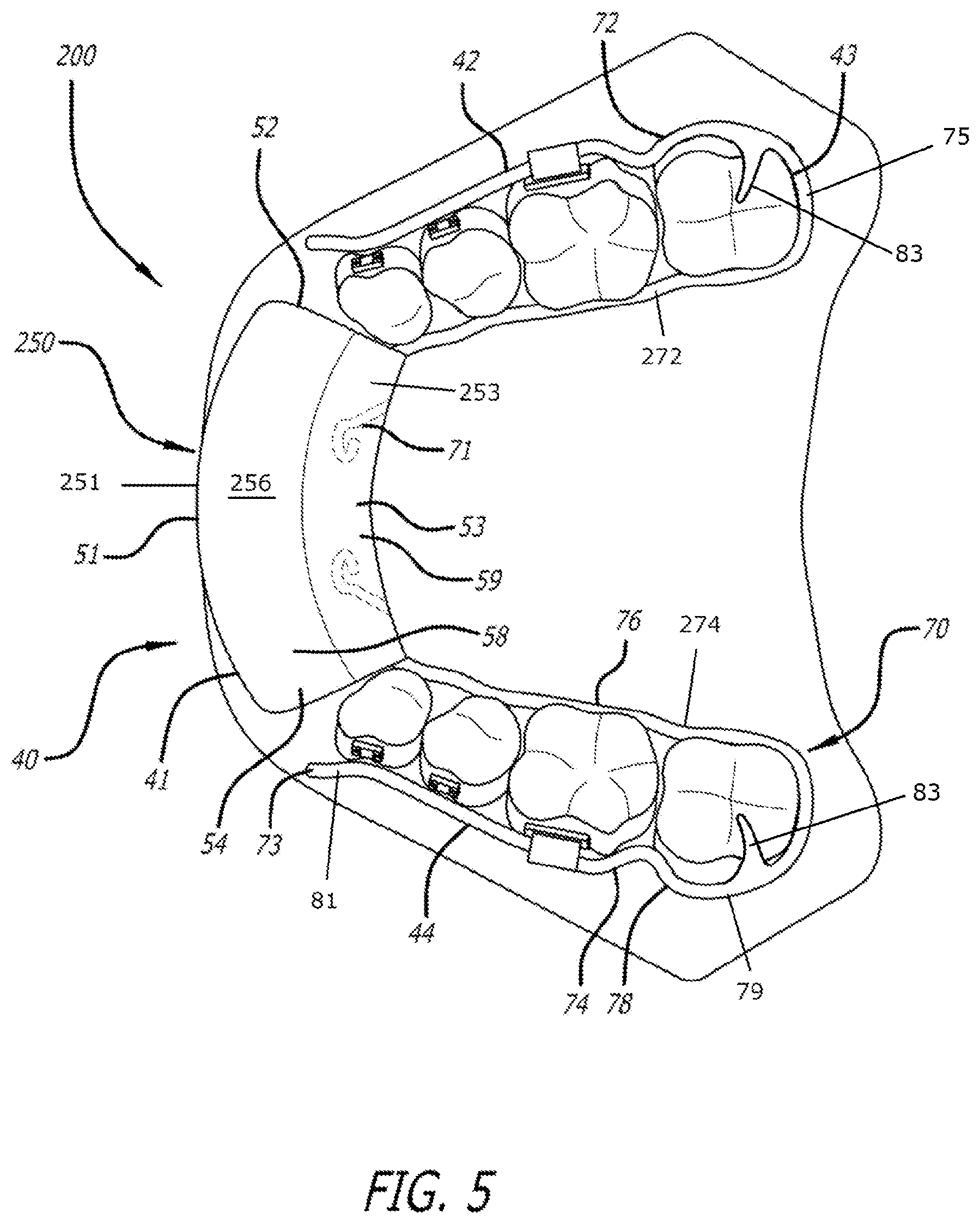 Patent US12303424 Figure 5 – Adjustable sleep apnea oral appliance for use with orthodontic braces