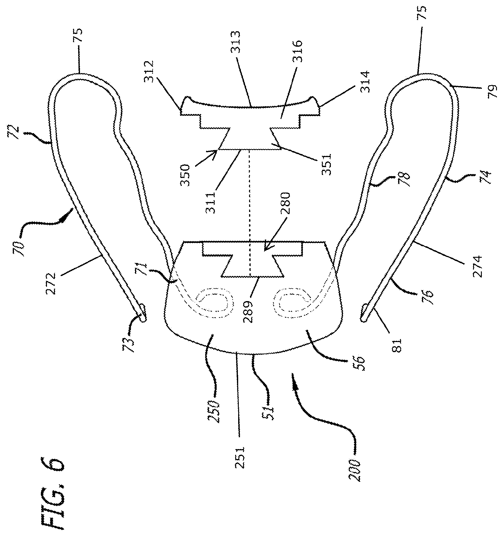 Patent US12303424 Figure 6 – Adjustable sleep apnea oral appliance for use with orthodontic braces