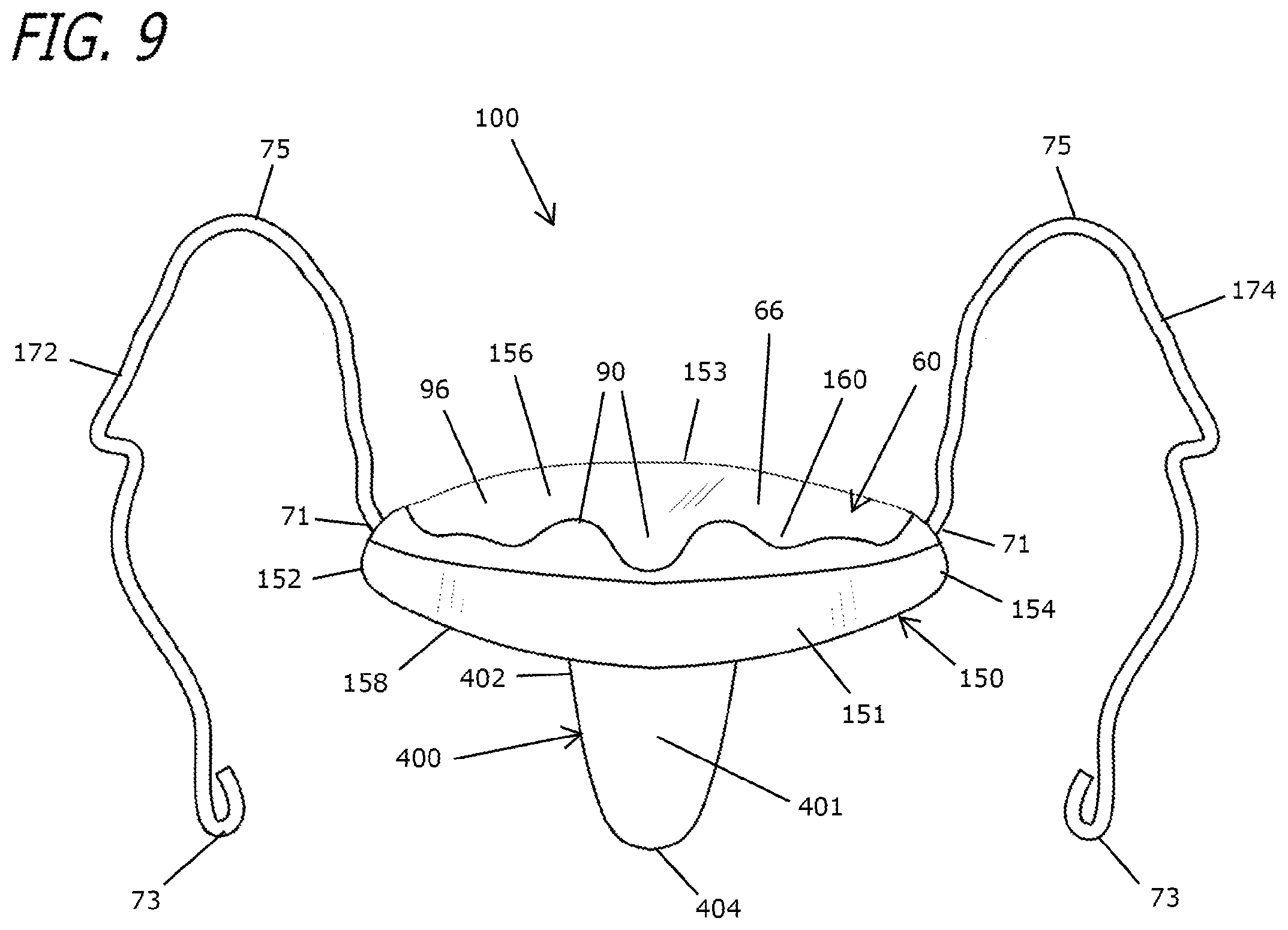 Patent US12303424 Figure 9 – Adjustable sleep apnea oral appliance for use with orthodontic braces