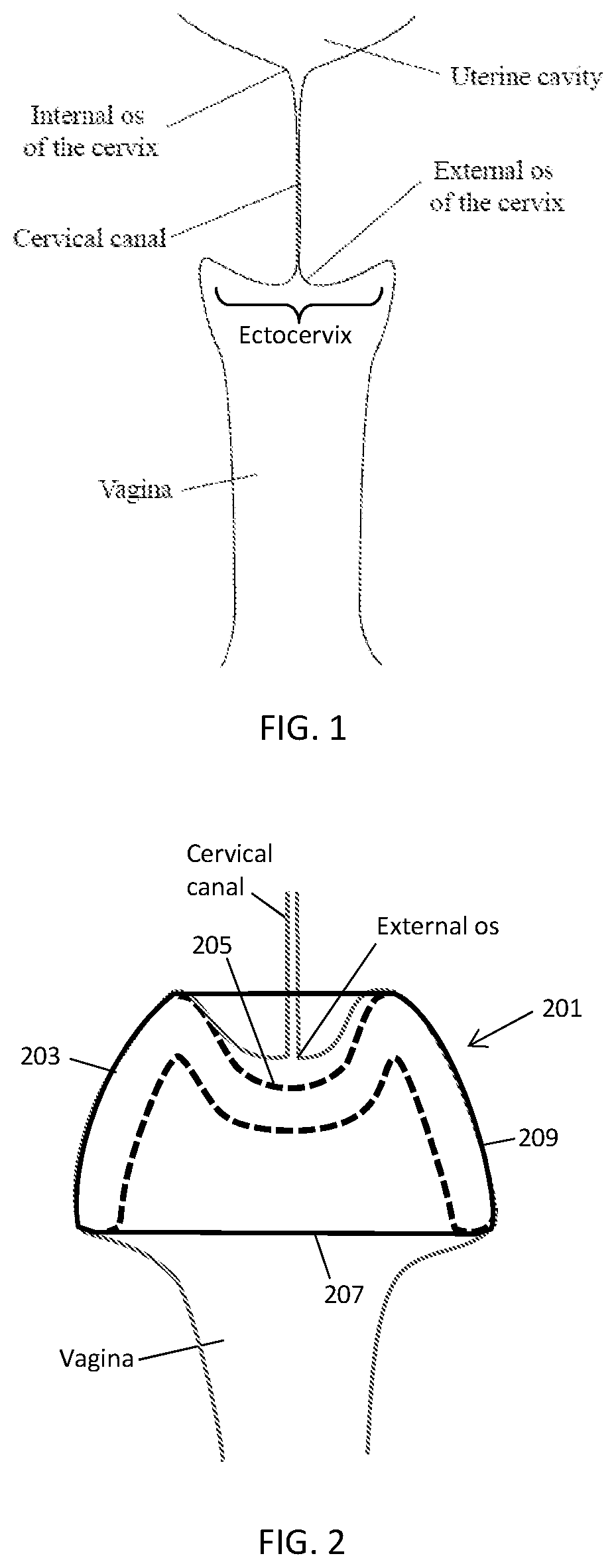 Patent US12303425 — Methods and devices to prevent premature birth, stillbirth, miscarriage, infection, or pregnancy — Figure 1