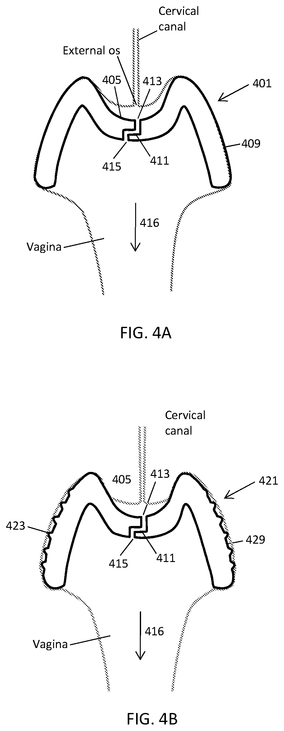 Patent US12303425 Figure 4 – Methods and devices to prevent premature birth, stillbirth, miscarriage, infection, or pregnancy