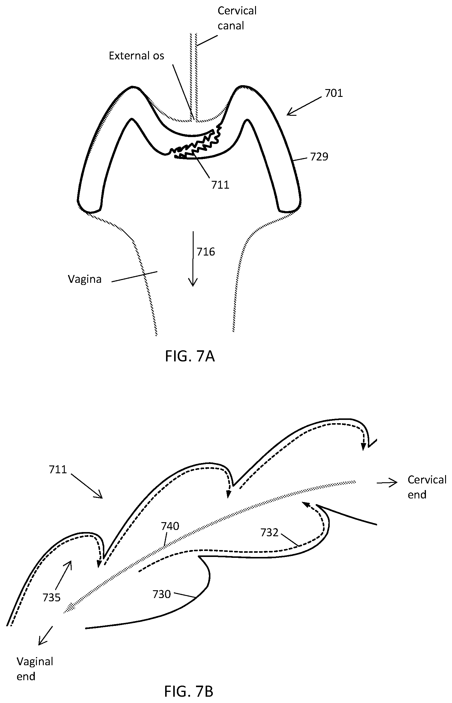 Patent US12303425 Figure 7 – Methods and devices to prevent premature birth, stillbirth, miscarriage, infection, or pregnancy
