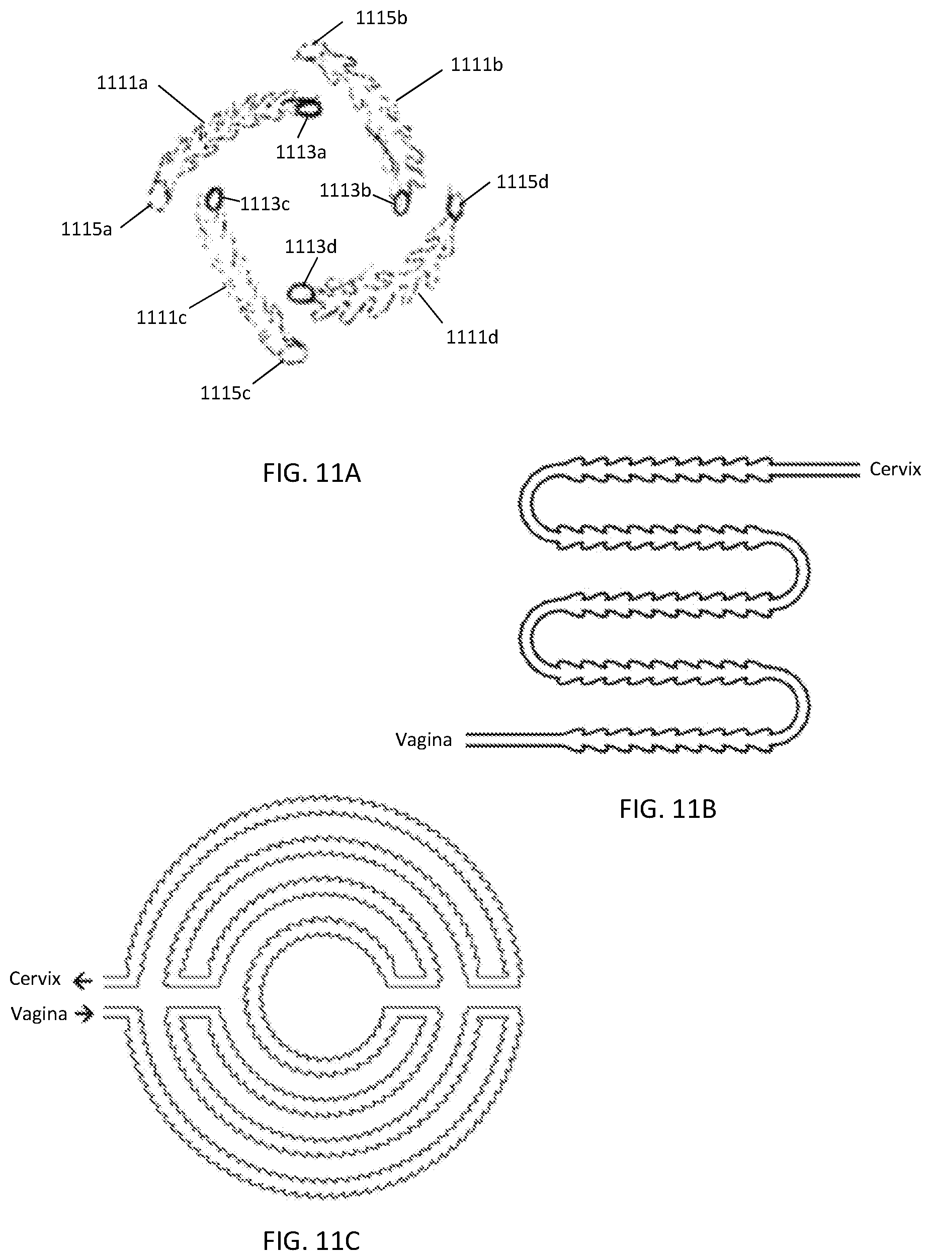 Patent US12303425 Figure 11 – Methods and devices to prevent premature birth, stillbirth, miscarriage, infection, or pregnancy