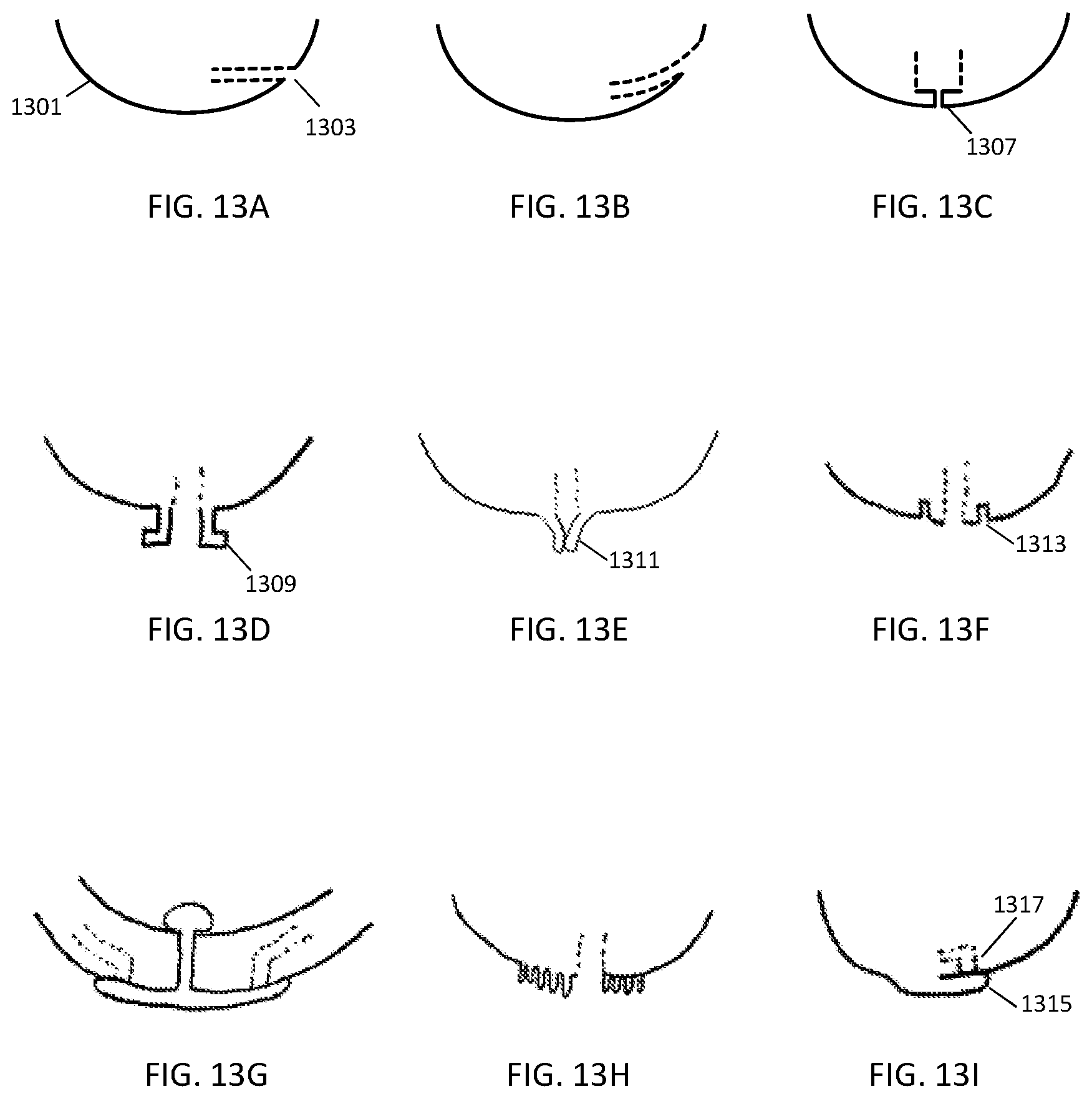 Patent US12303425 Figure 13 – Methods and devices to prevent premature birth, stillbirth, miscarriage, infection, or pregnancy