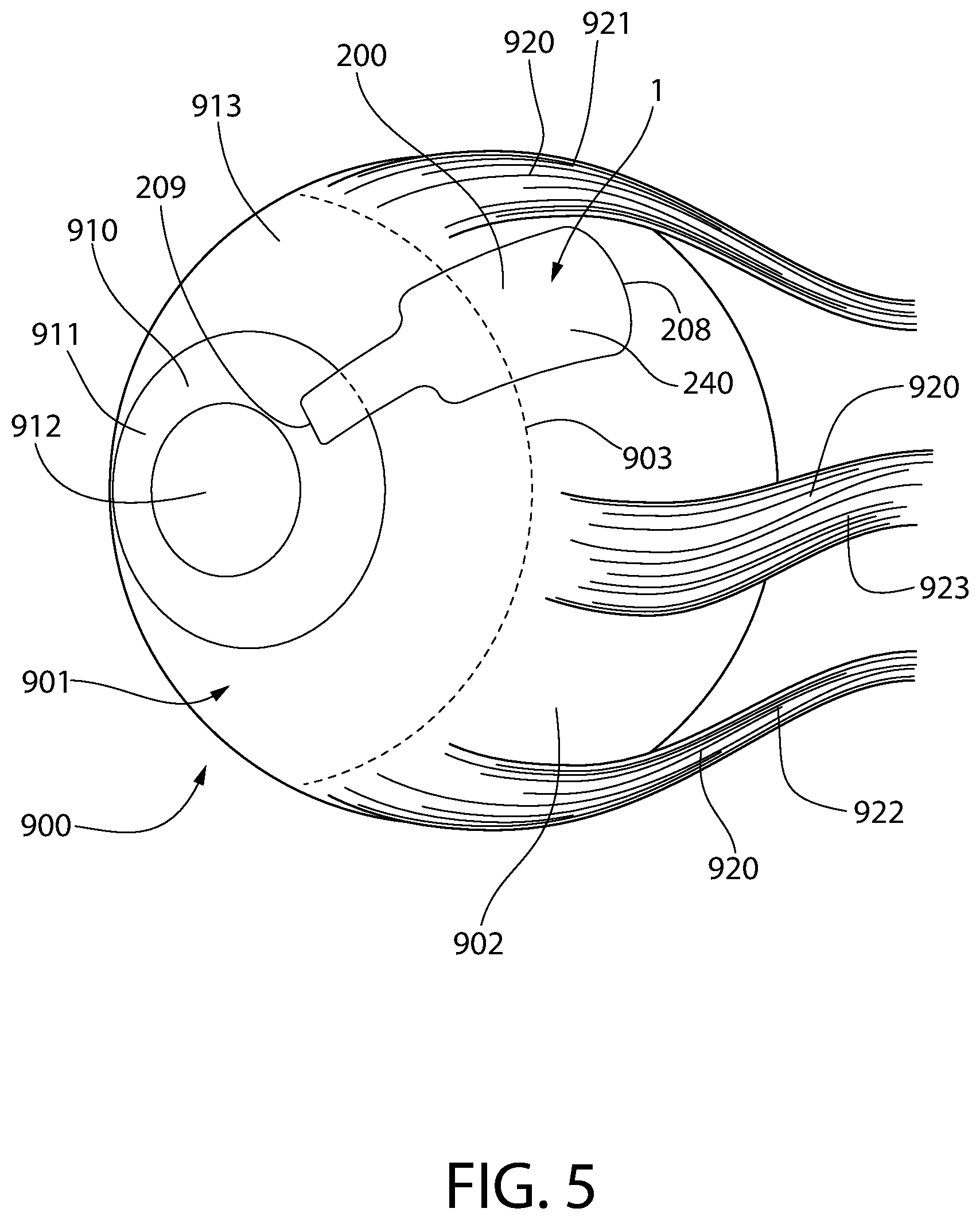 Patent US12303429 Figure 5 – Method and device for treating eye disease