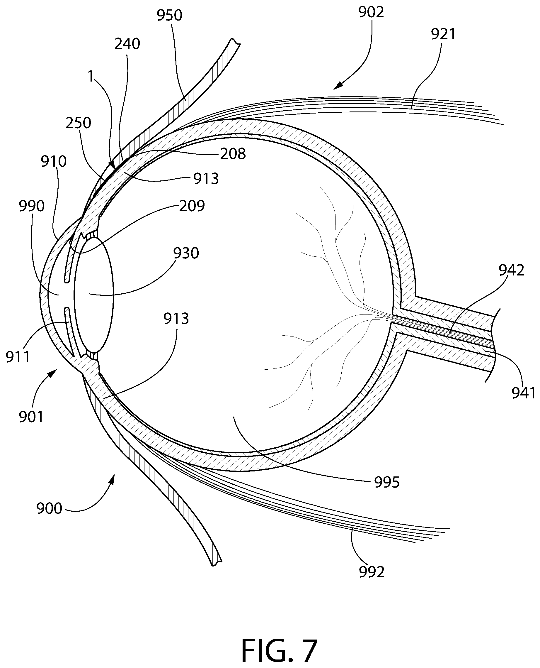 Patent US12303429 Figure 7 – Method and device for treating eye disease
